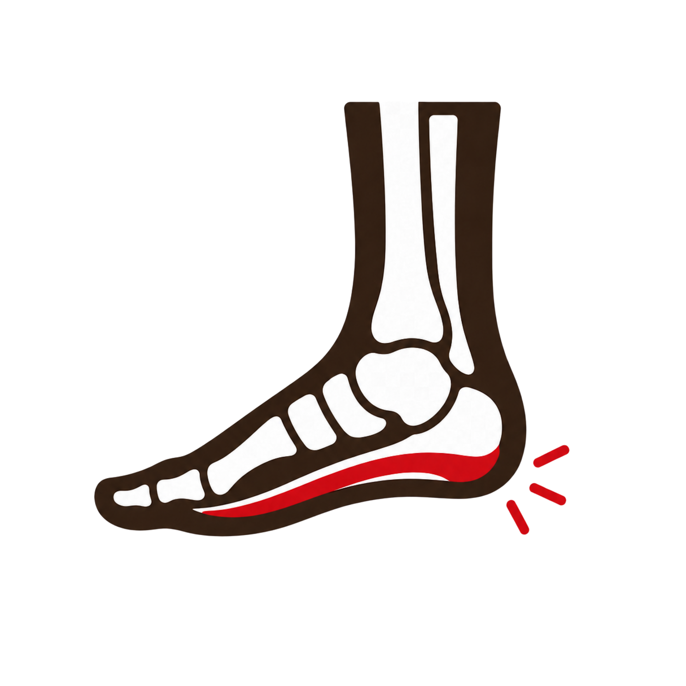 Plantar Fasciitis