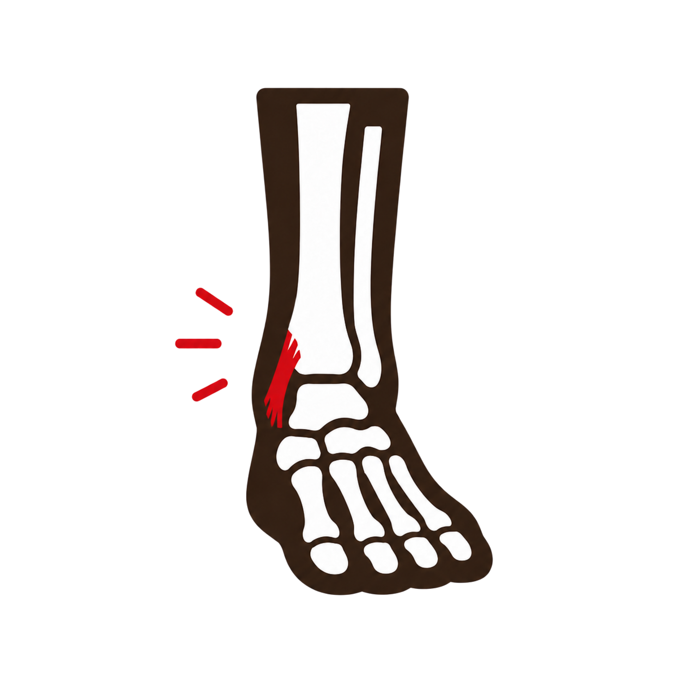 Lateral Ankle Sprain