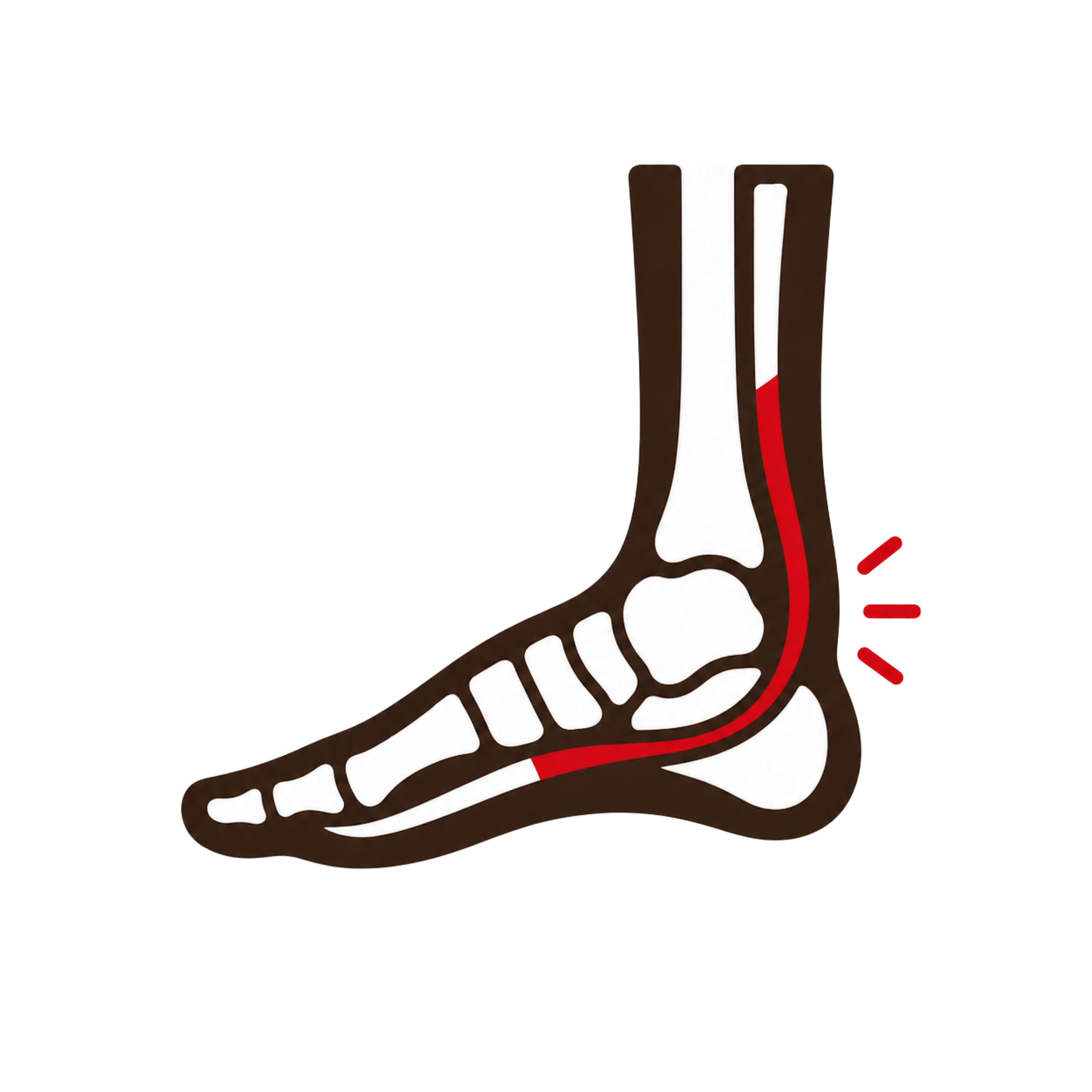 Posterior Tibial Tendinopathy