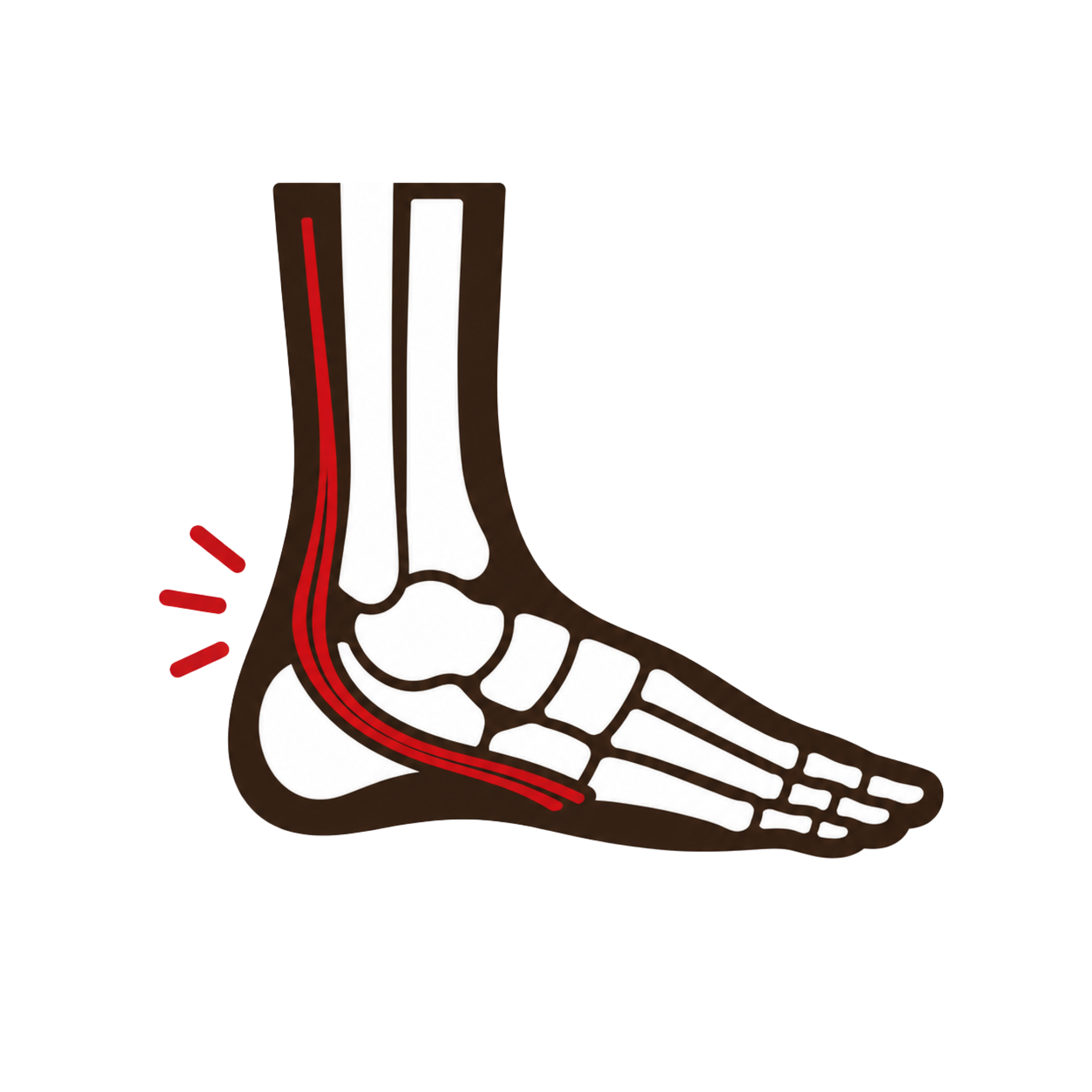 Peroneal Tendinopathy
