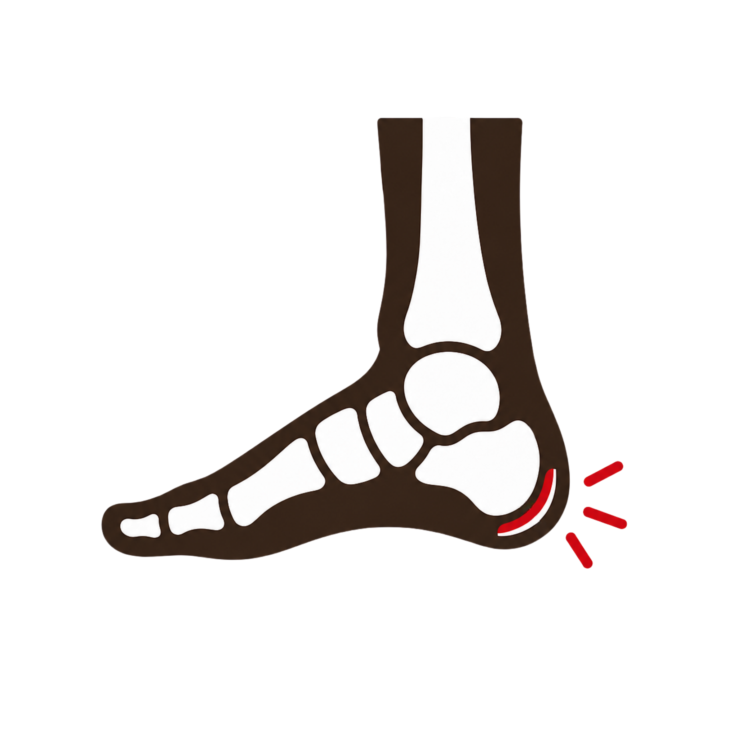 Sever's Disease