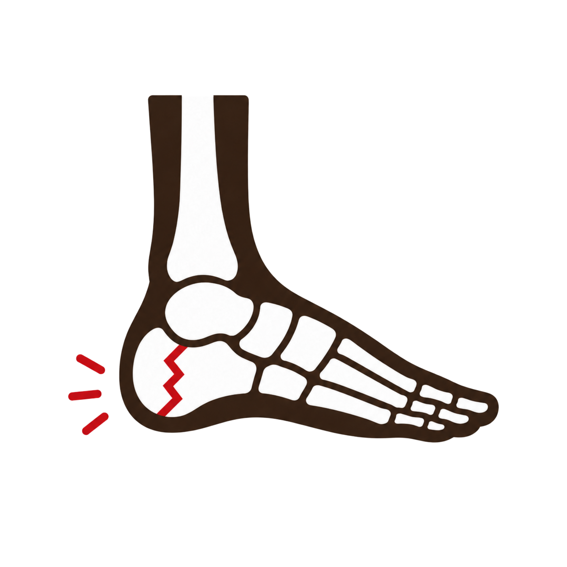 Stress Fractures of the Calcaneus