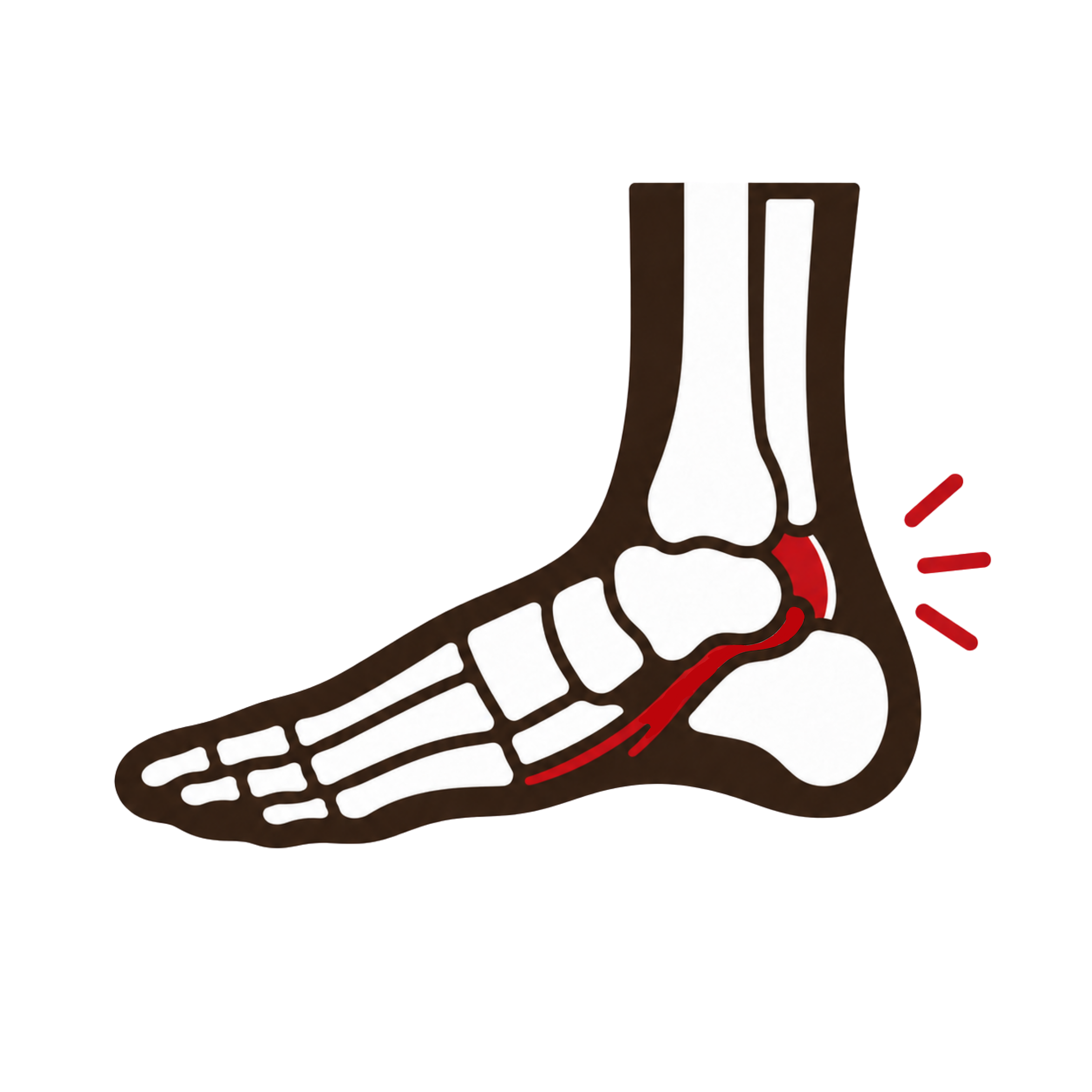 Tarsal Tunnel Syndrome