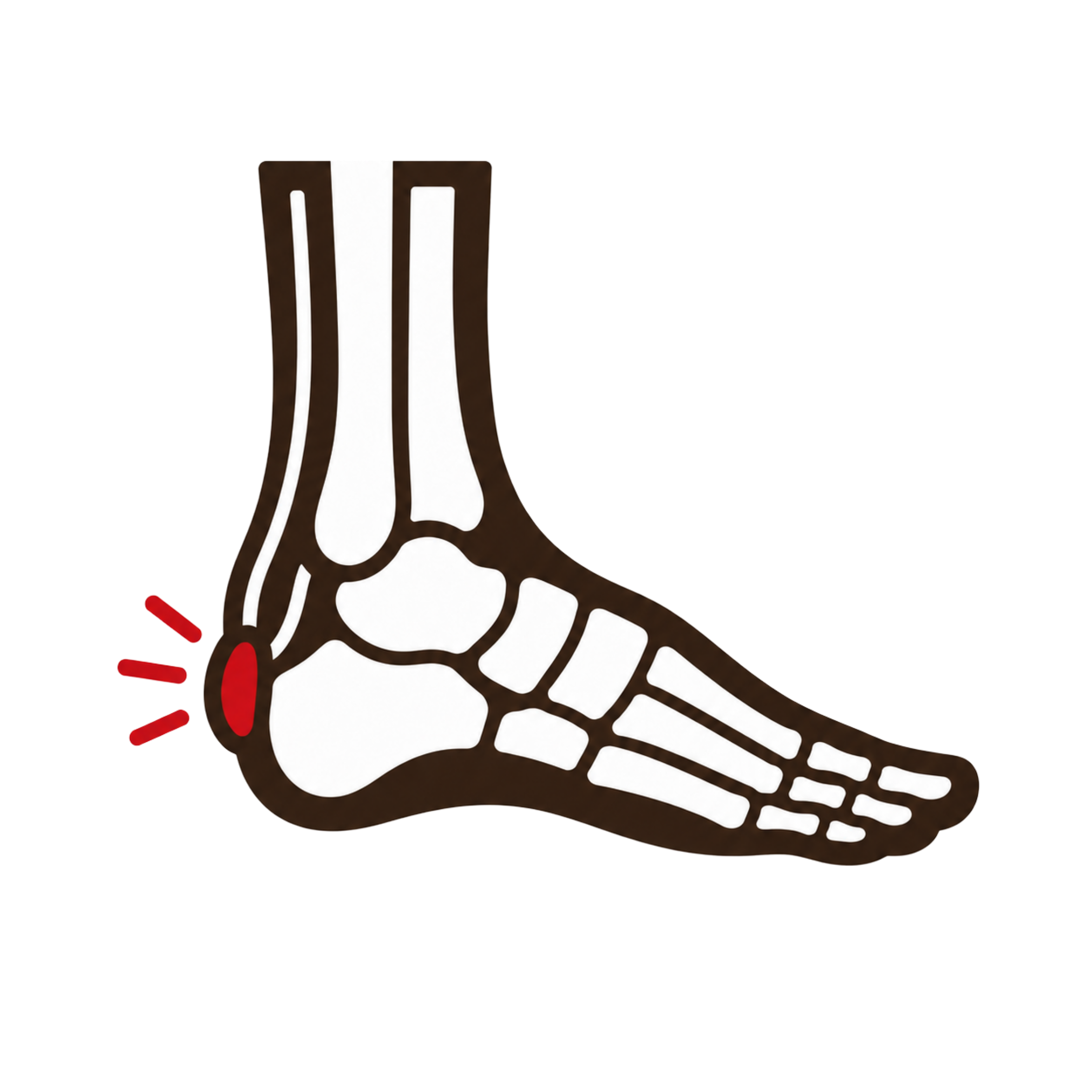 Retrocalcaneal Bursitis