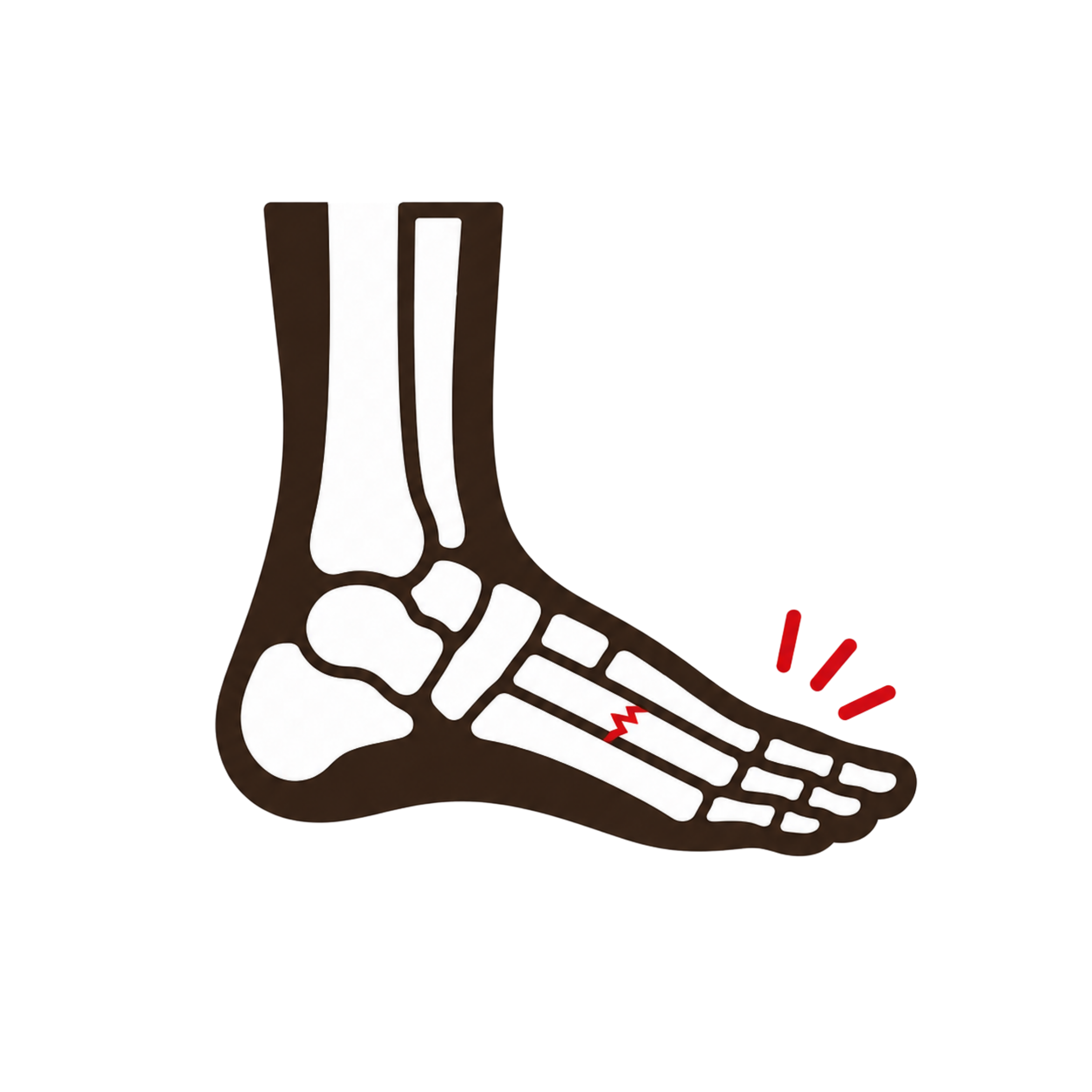 Stress Fractures of the Metatarsals