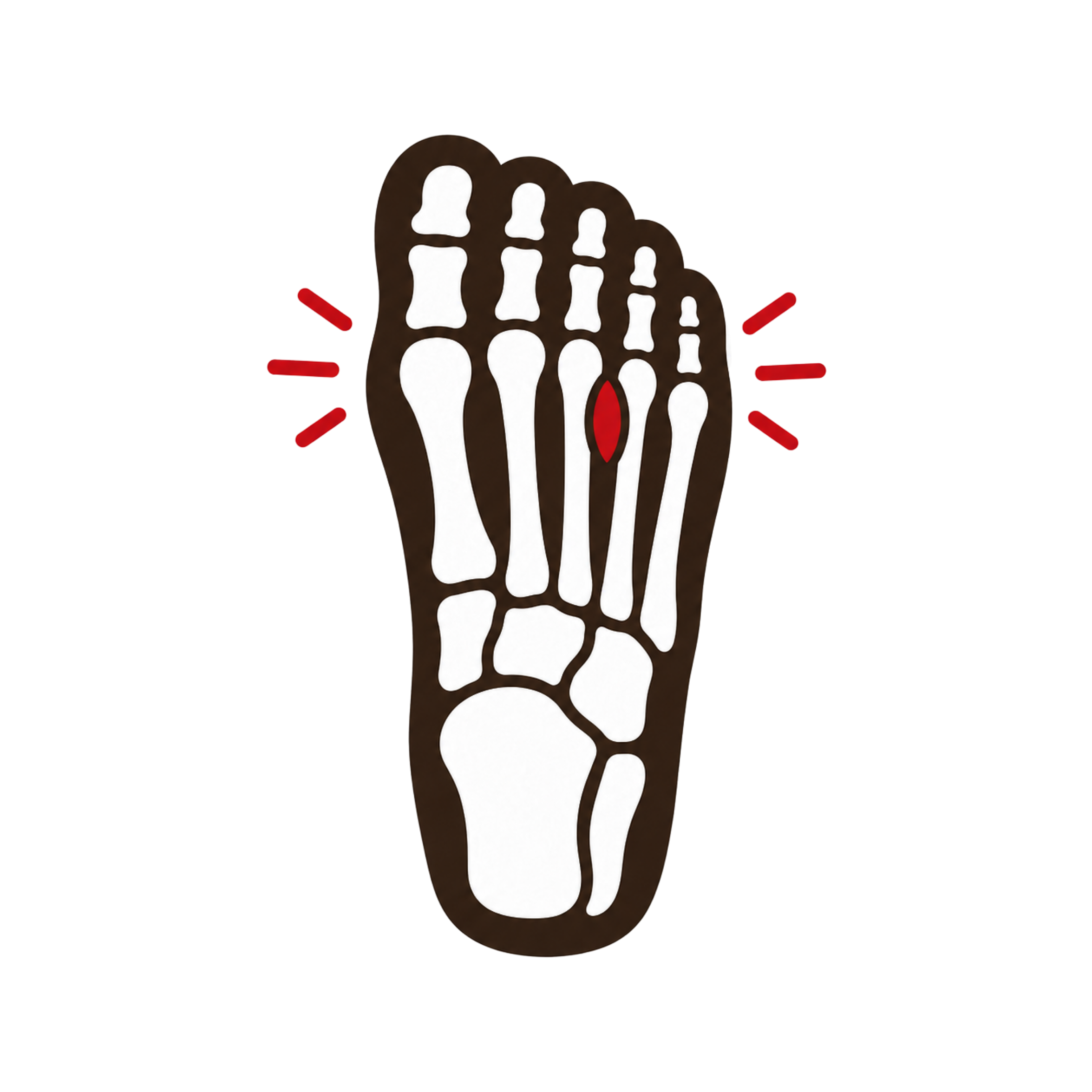Morton's Neuroma