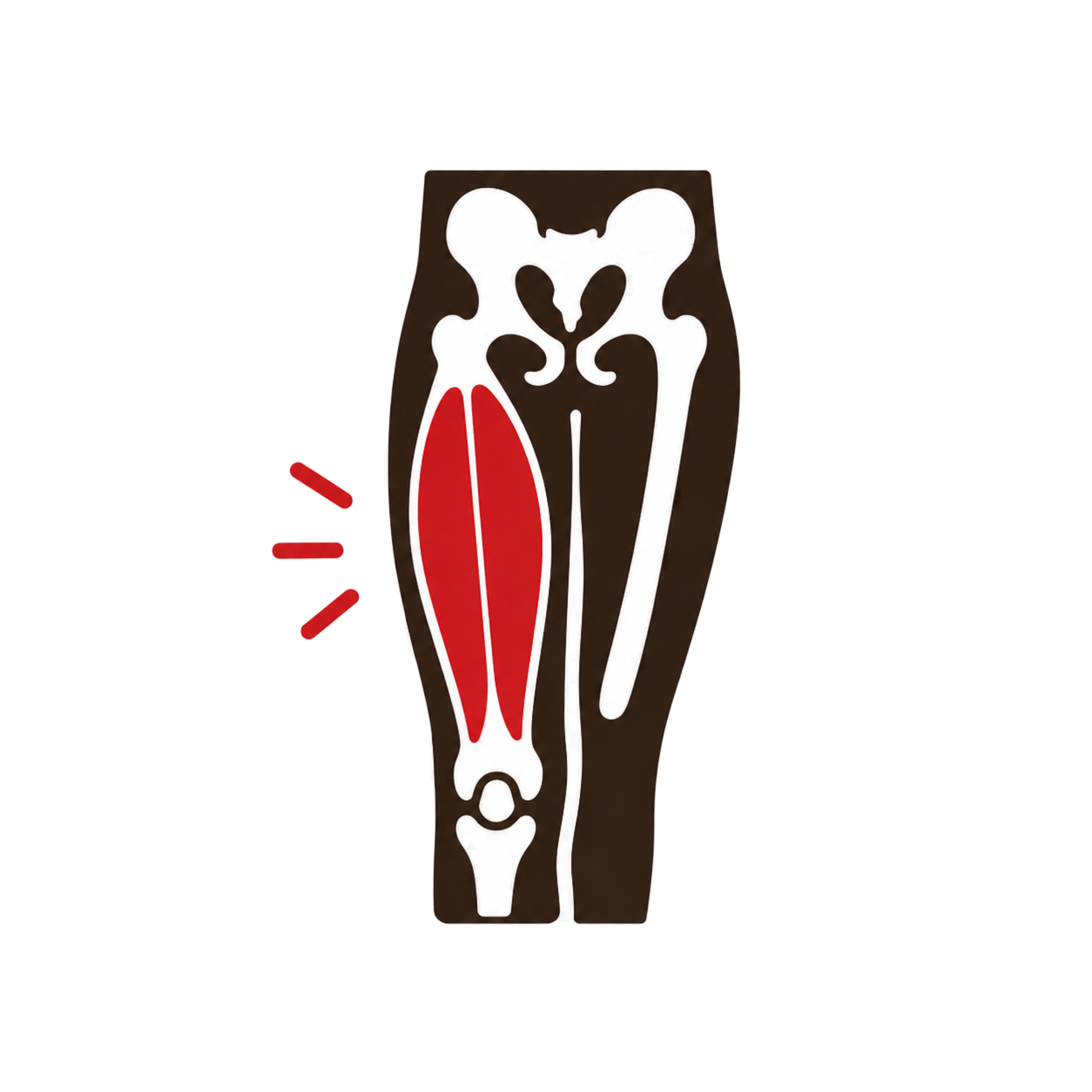 Quadriceps Strain