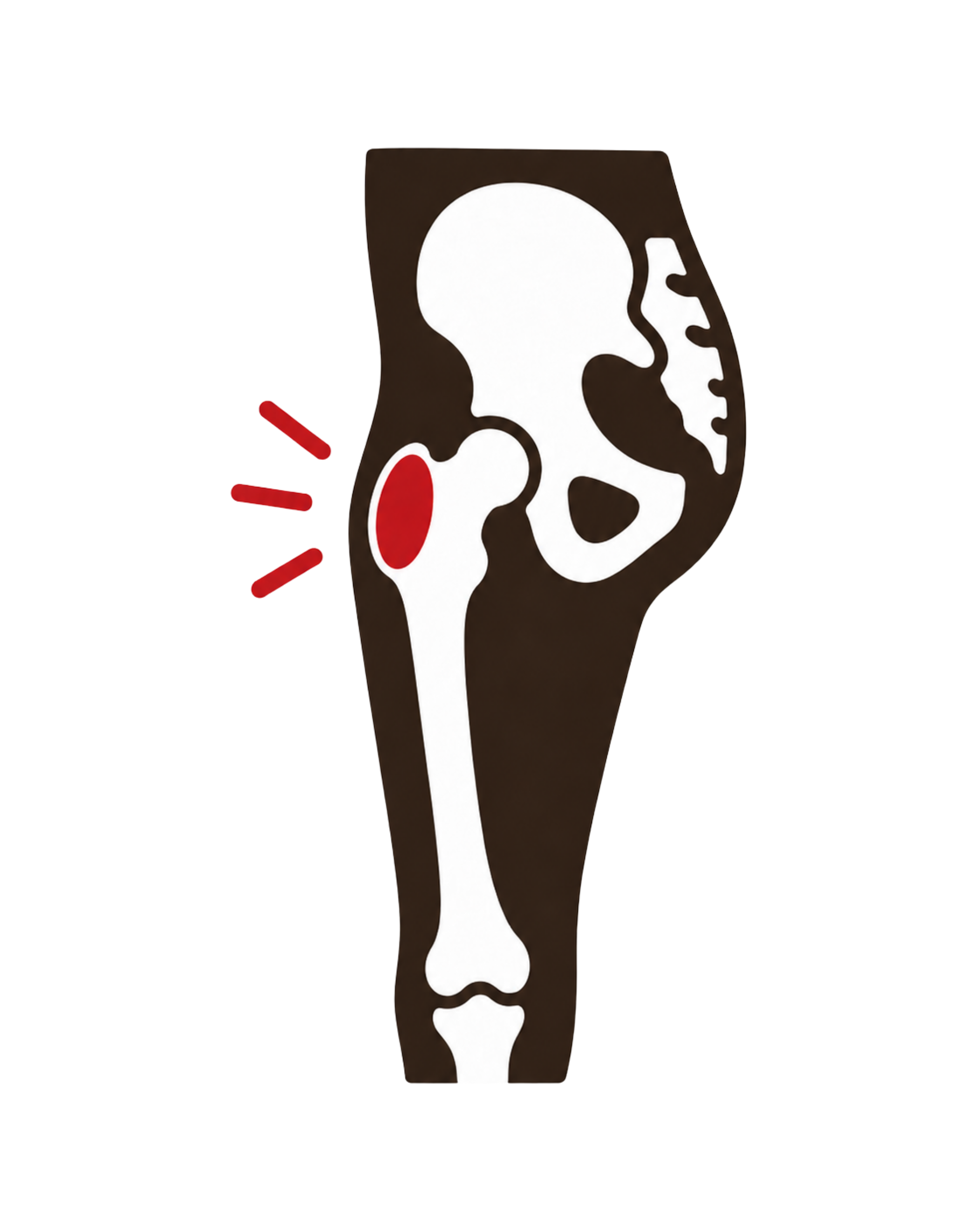 Greater Trochanteric Pain Syndrome