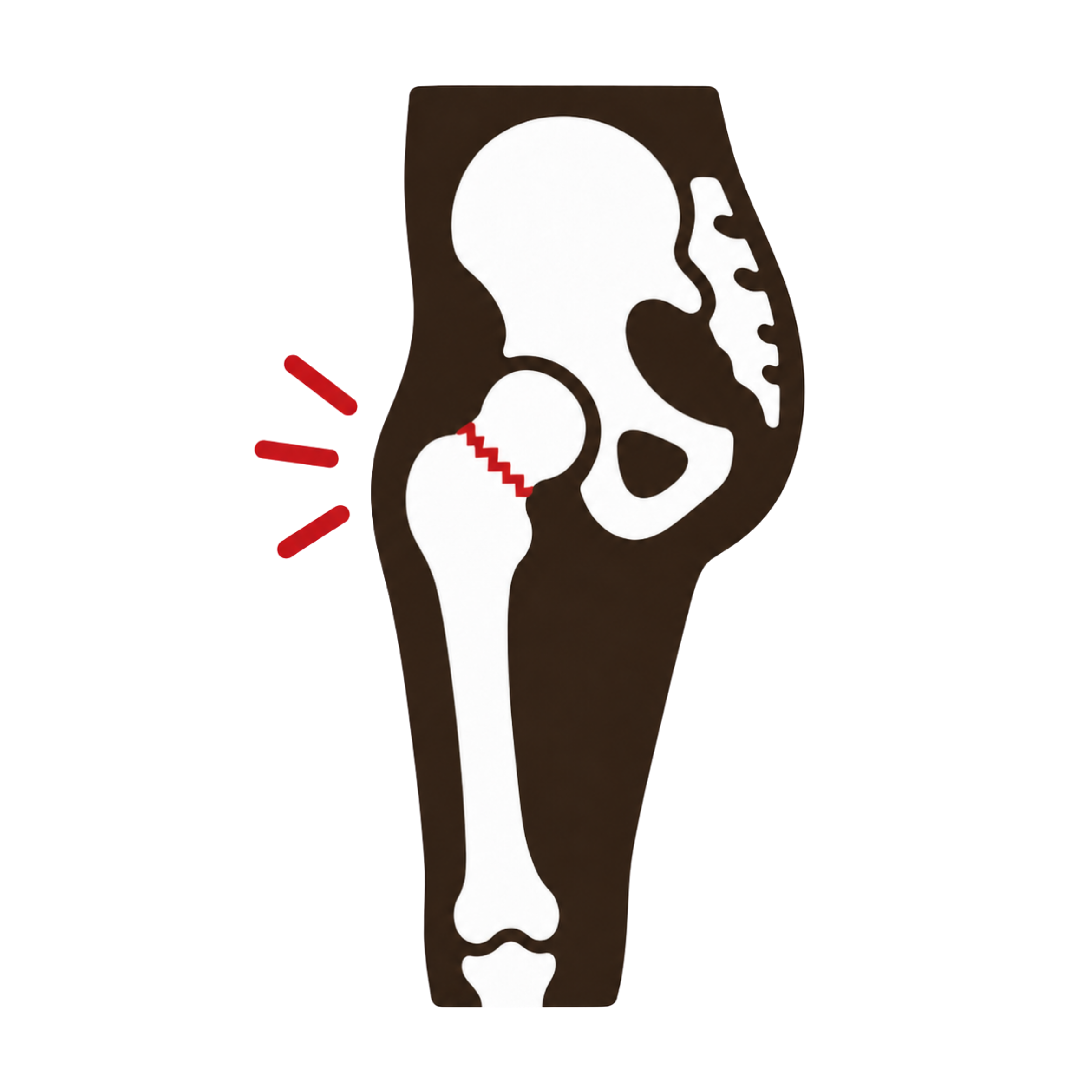 Femoral Neck Stress Fractures