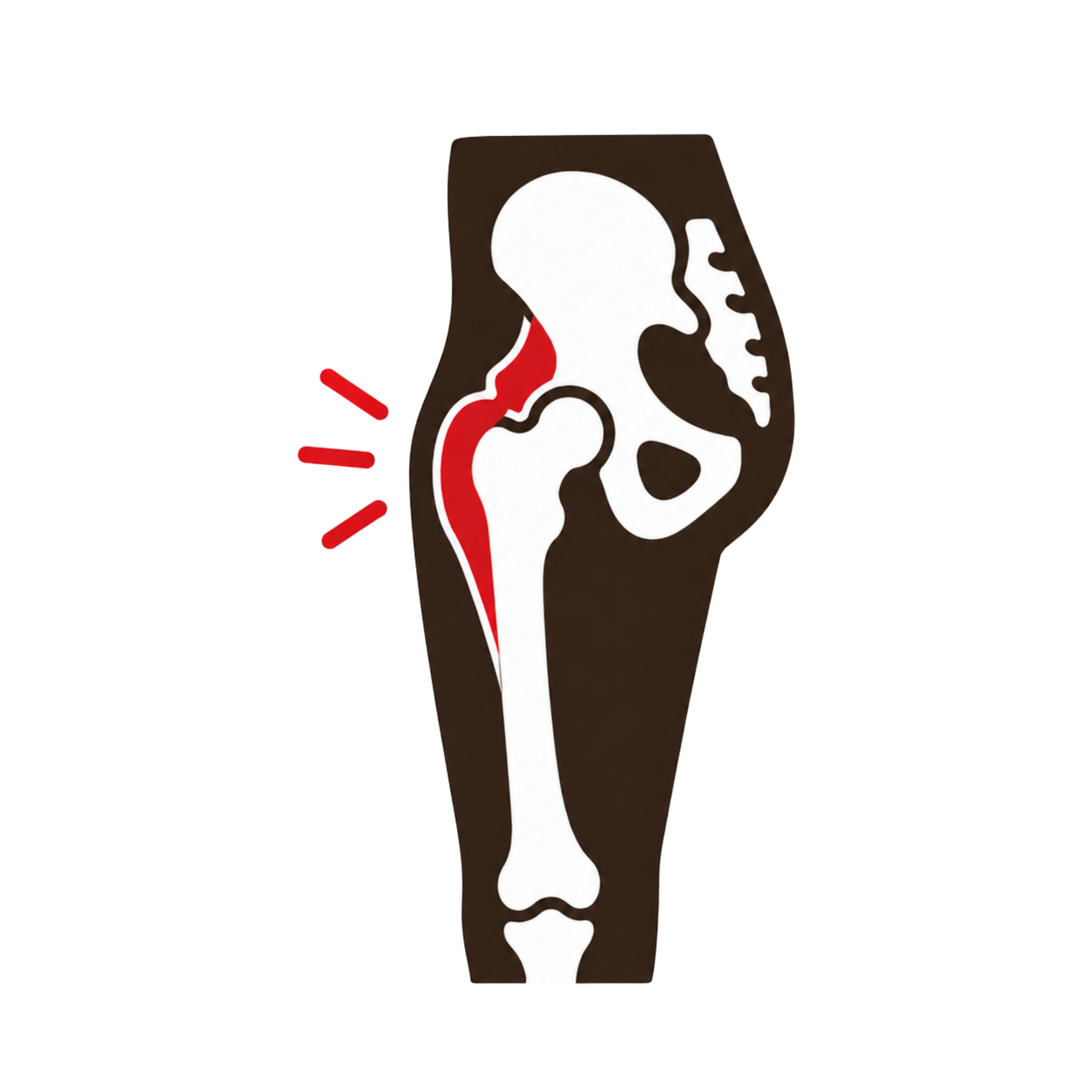 Snapping Hip Syndrome