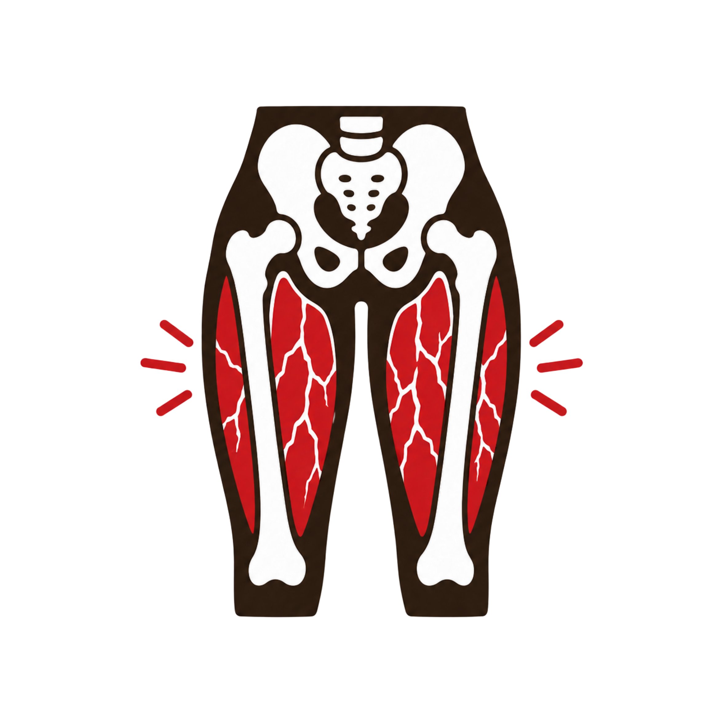 Exertional Rhabdomyolysis
