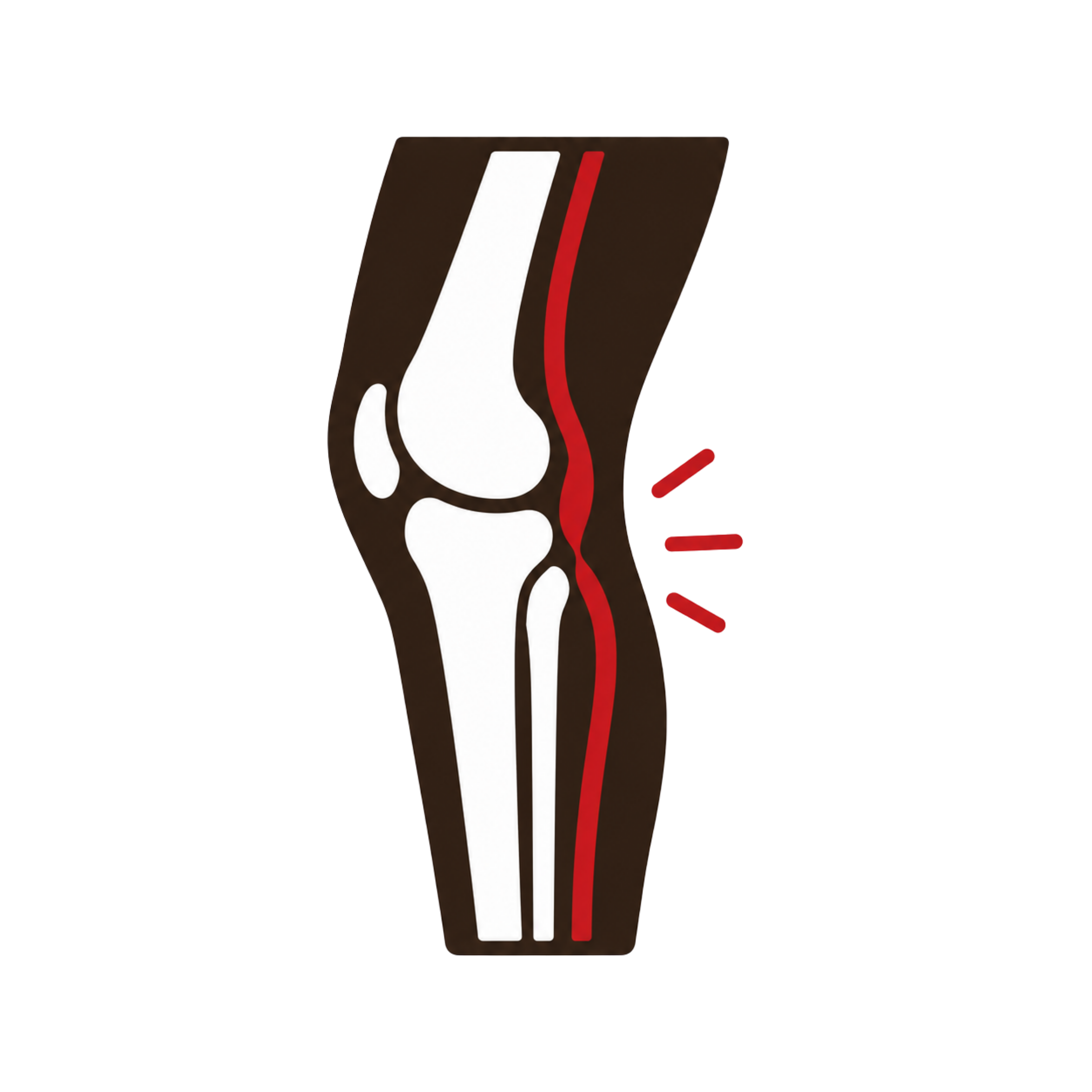 Popliteal Artery Entrapment Syndrome (PAES)