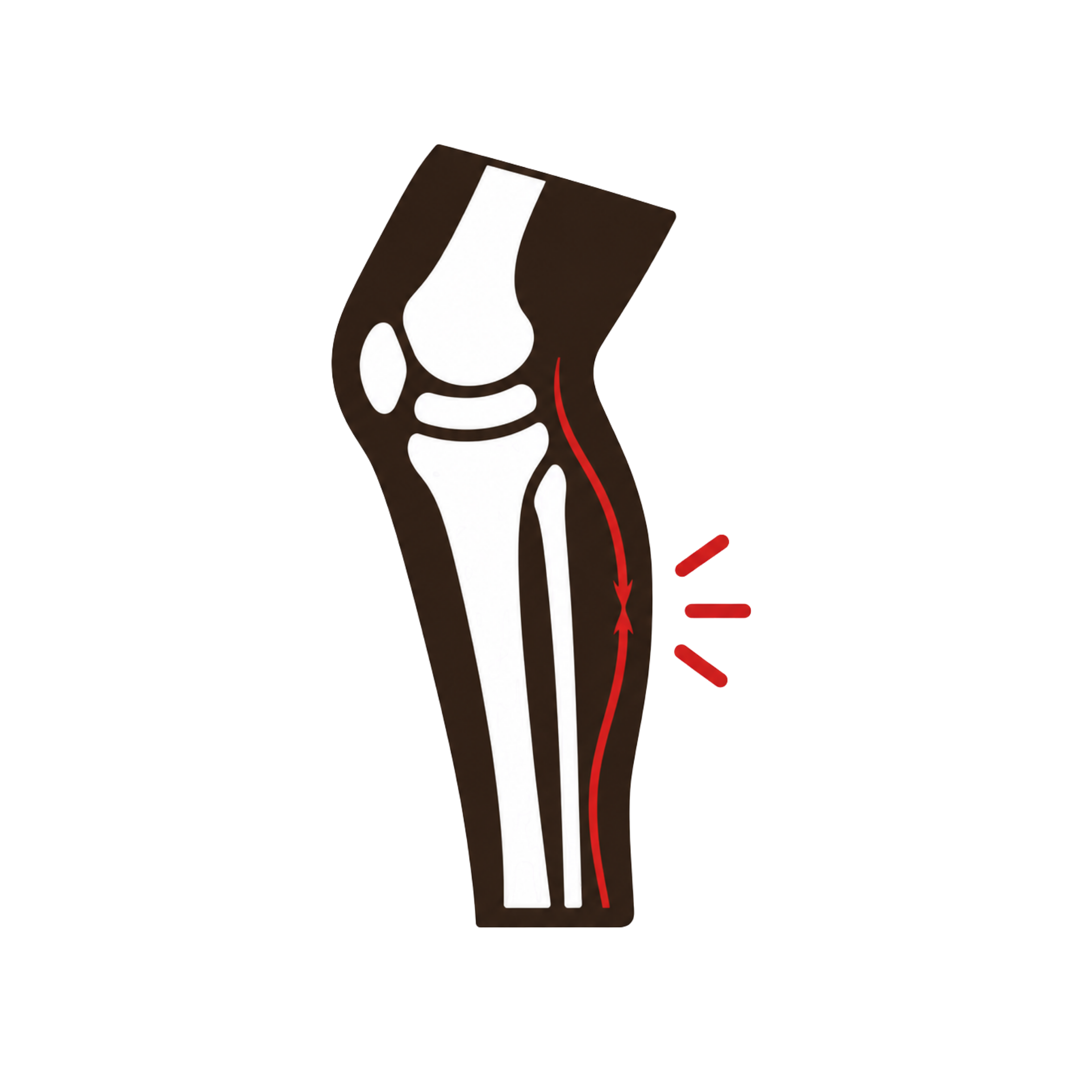 Nerve Entrapment Syndromes