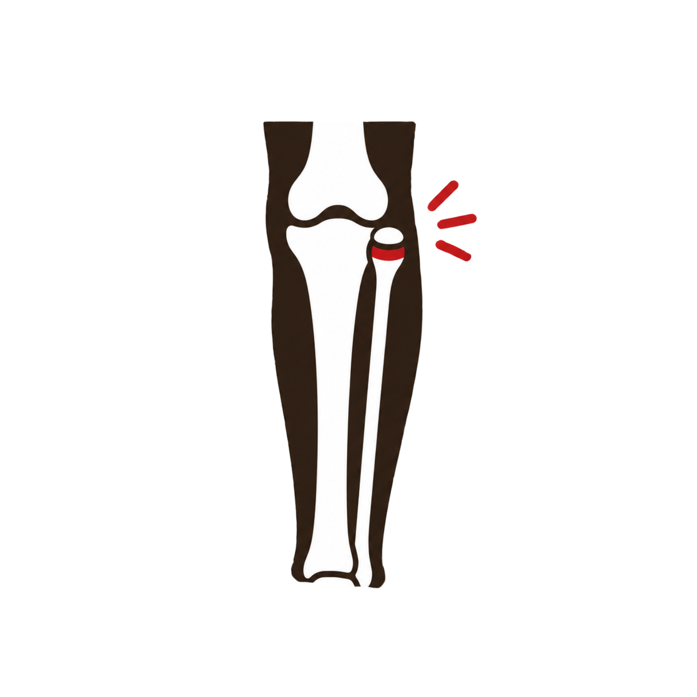 Tibiofibular Joint Sprain