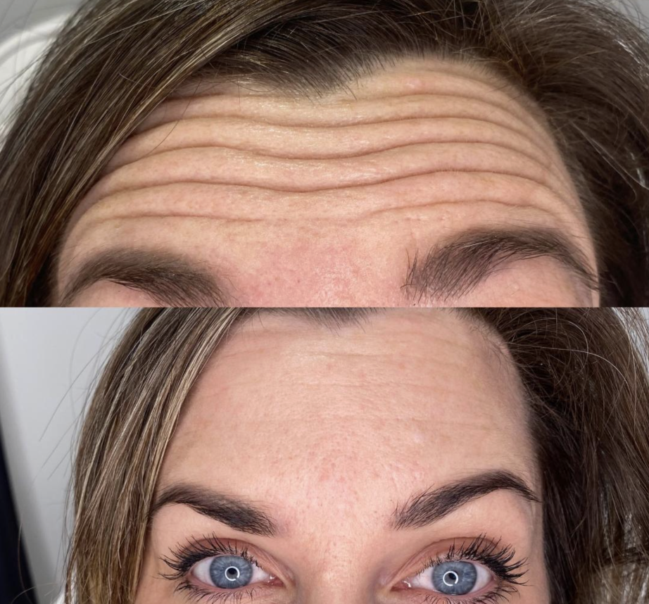 Comparison of a woman's forehead before and after treatment or makeup, showing reduced wrinkles and smoother skin.