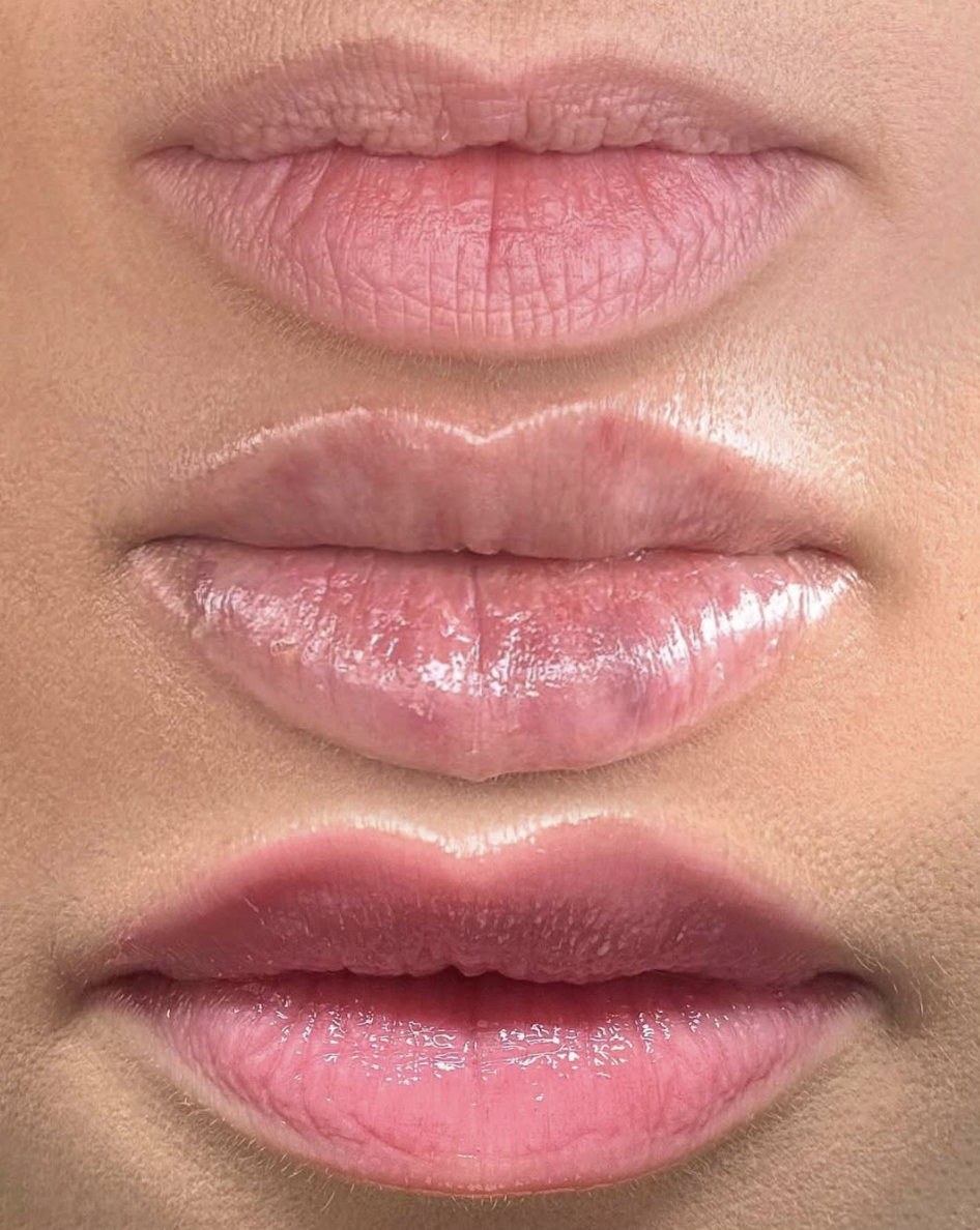 Dermal filler in Rustington results natural