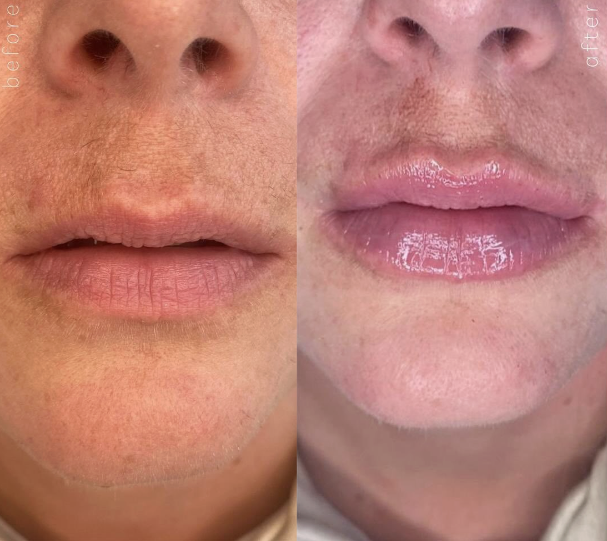 Close-up of a person's face showing before and after images of lip enhancement. The left side displays natural lips, and the right side shows lips after treatment with a shiny, plump appearance.