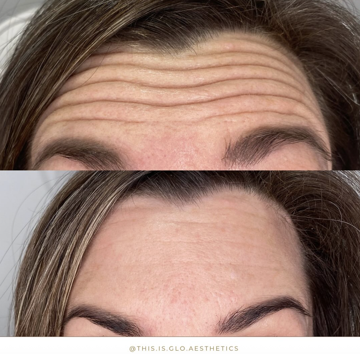Close-up of a woman's forehead showing before and after comparison of wrinkle reduction, with smoother skin in the lower image.