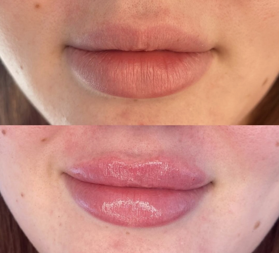 Dermal filler in lips in Rustington, West Sussex