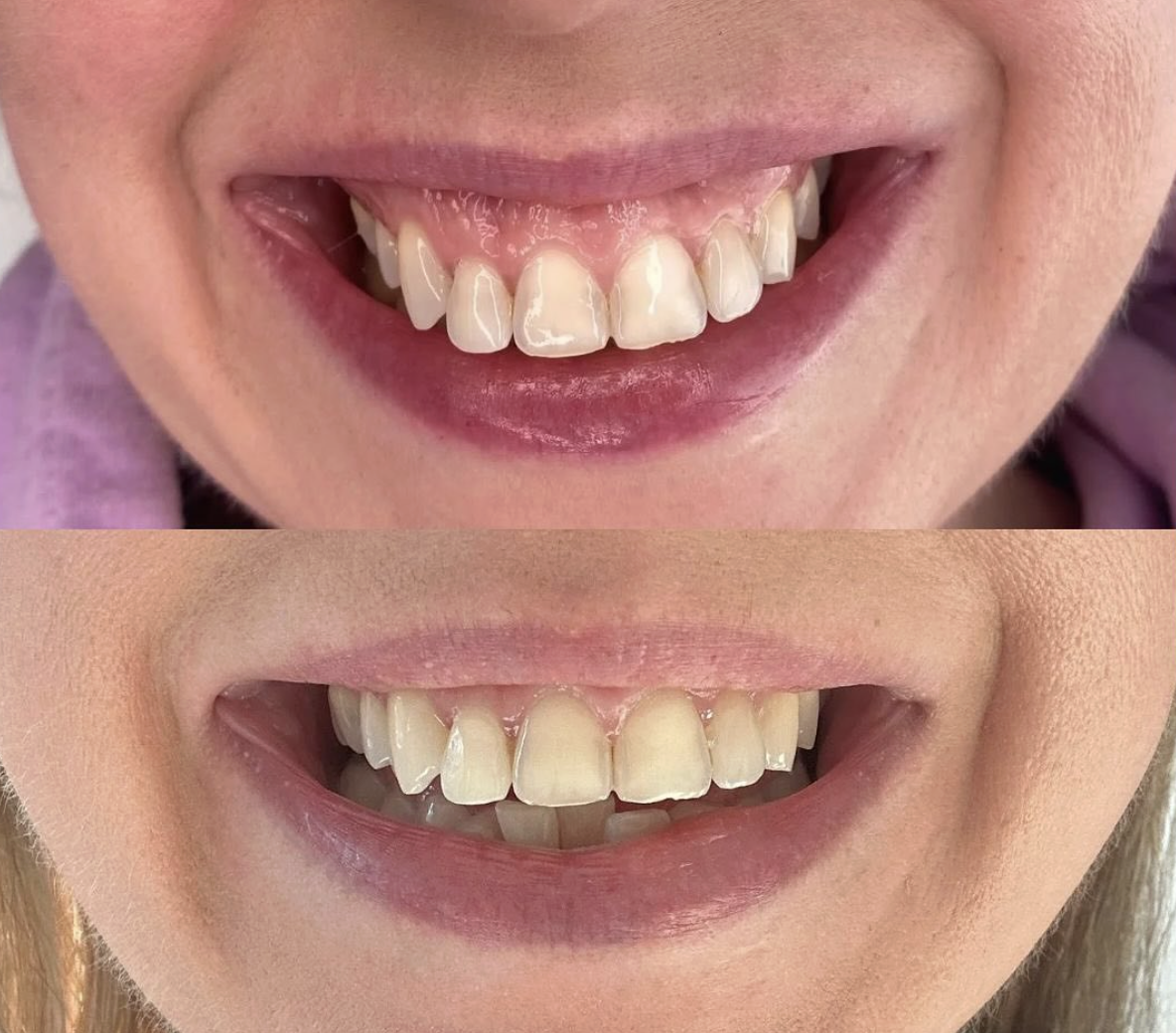Before and after comparison of teeth with dental work, showing improved alignment and appearance.