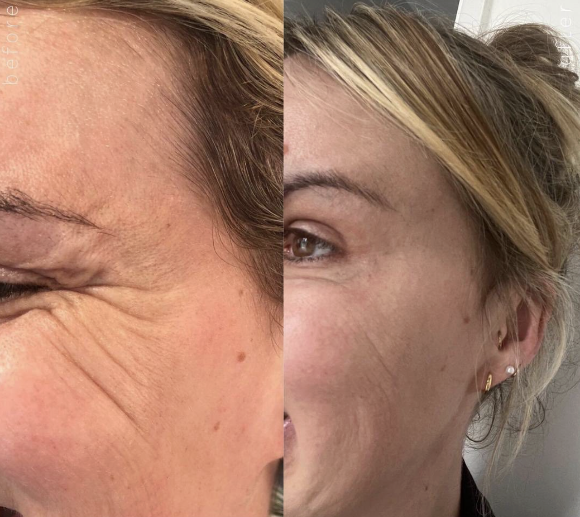 Comparison of a woman's face before and after skincare, showing smoother skin and fewer wrinkles on the right.