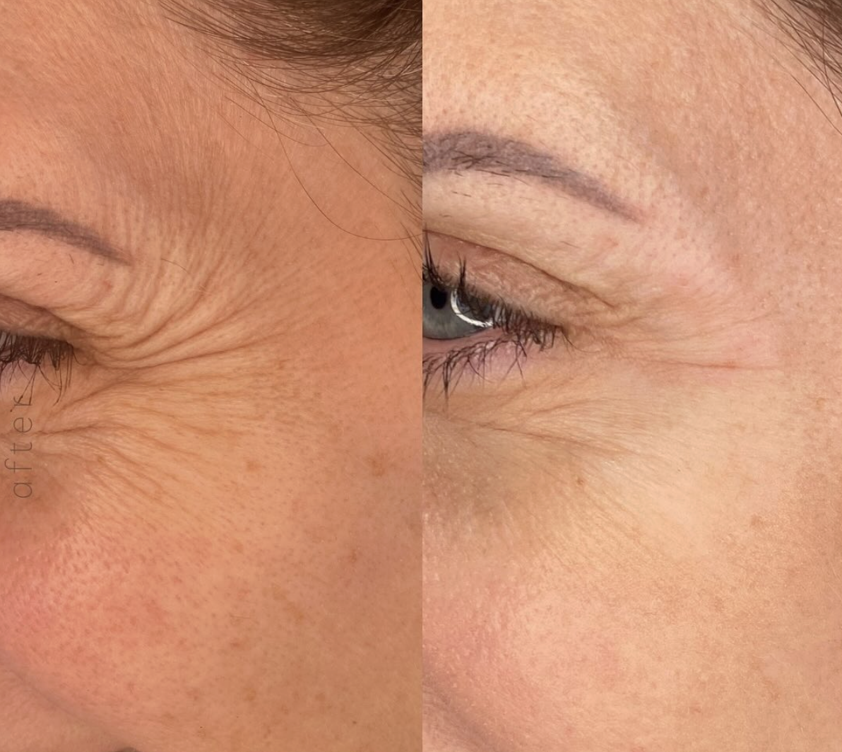 Close-up comparison of a person's face, showing the effects of facial aging on the left side with wrinkles and fine lines, and smoother skin on the right side after skincare or cosmetic treatment.