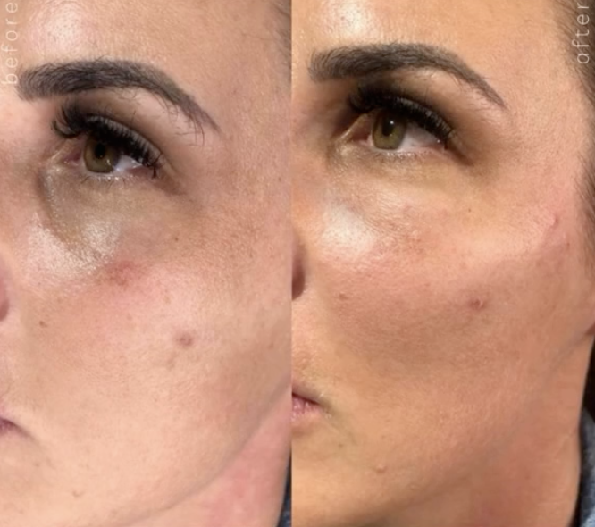 Natural results from cheek dermal filler in Rustington, West Sussex