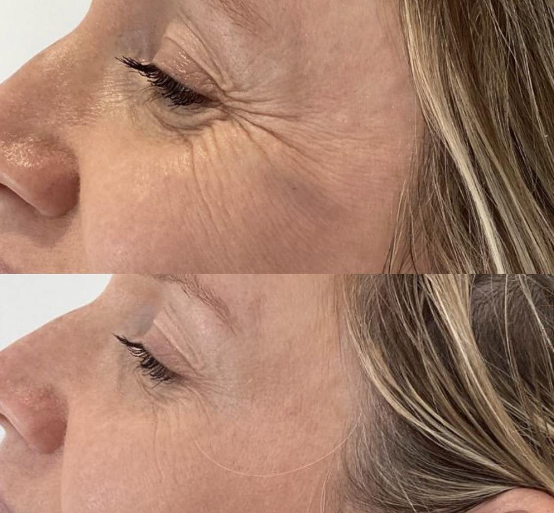 Close-up of a woman's face showing a comparison of skin appearance before and after skincare, with visible reduction in wrinkles around the eye area.