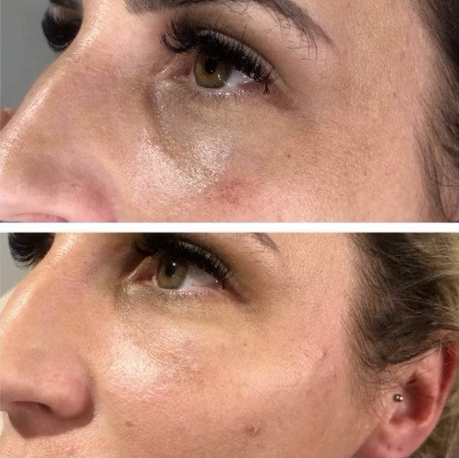 Close-up of a woman's face showing a before and after comparison of skin condition around her eye and cheek area, highlighting reduced blemishes and smoother skin.