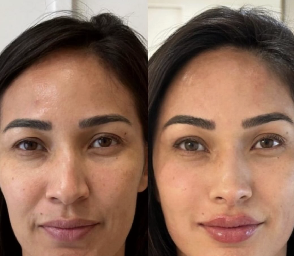 Side-by-side comparison of a woman's face before and after skincare or cosmetic treatment, showing clearer skin and enhanced facial features.