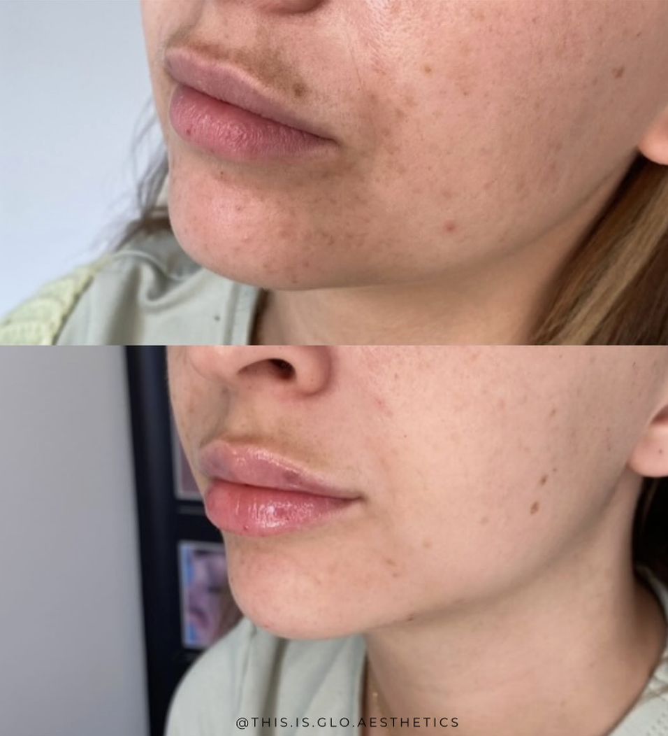 Close-up of a woman's face showing the lower half, before and after skincare treatment. The 'before' shows acne-prone skin with redness and spots, the 'after' shows clearer, smoother skin with reduced redness.