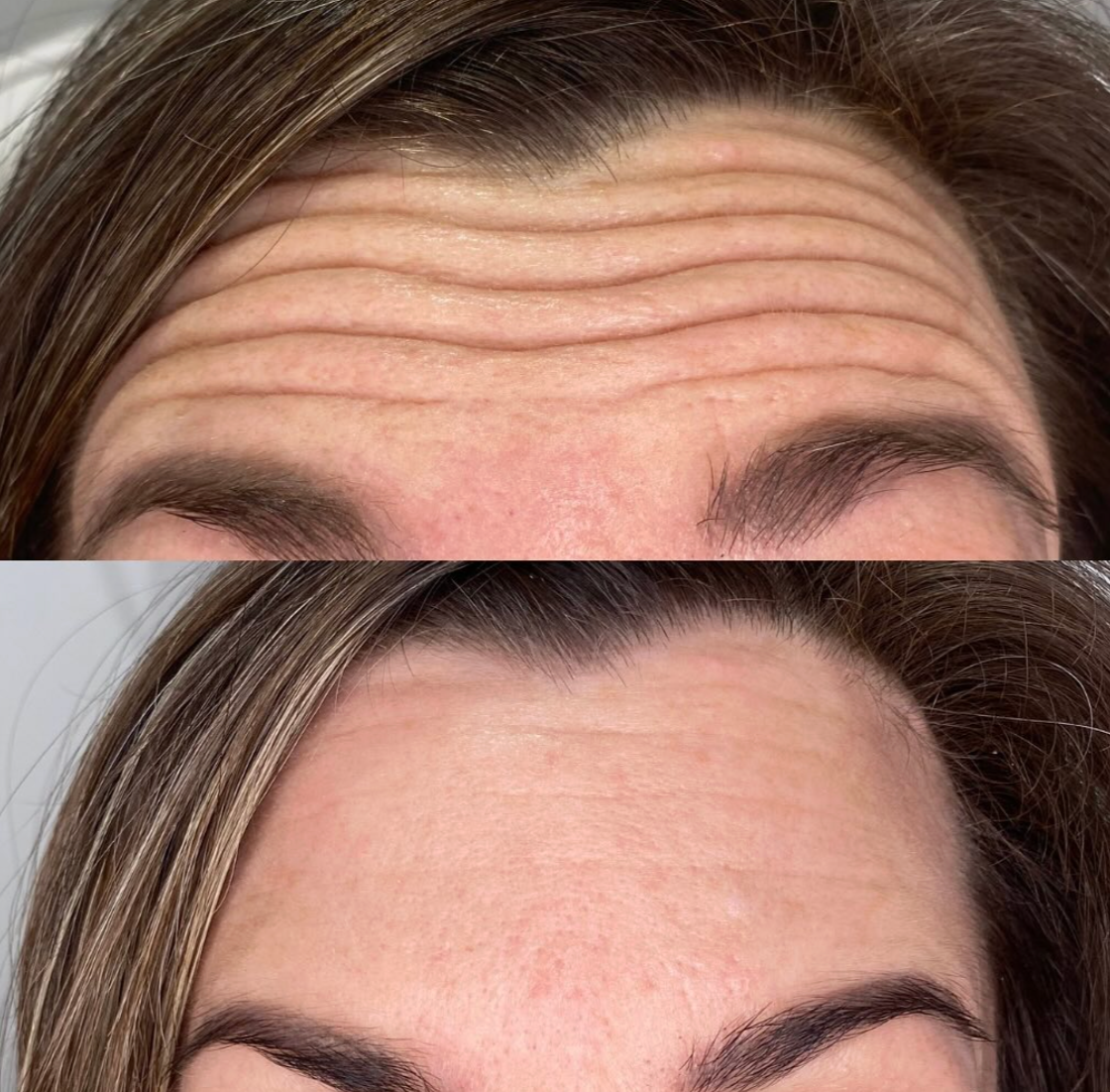 Forehead lines natural results from anti-wrinkle injections Botox in Rustington, West Sussex