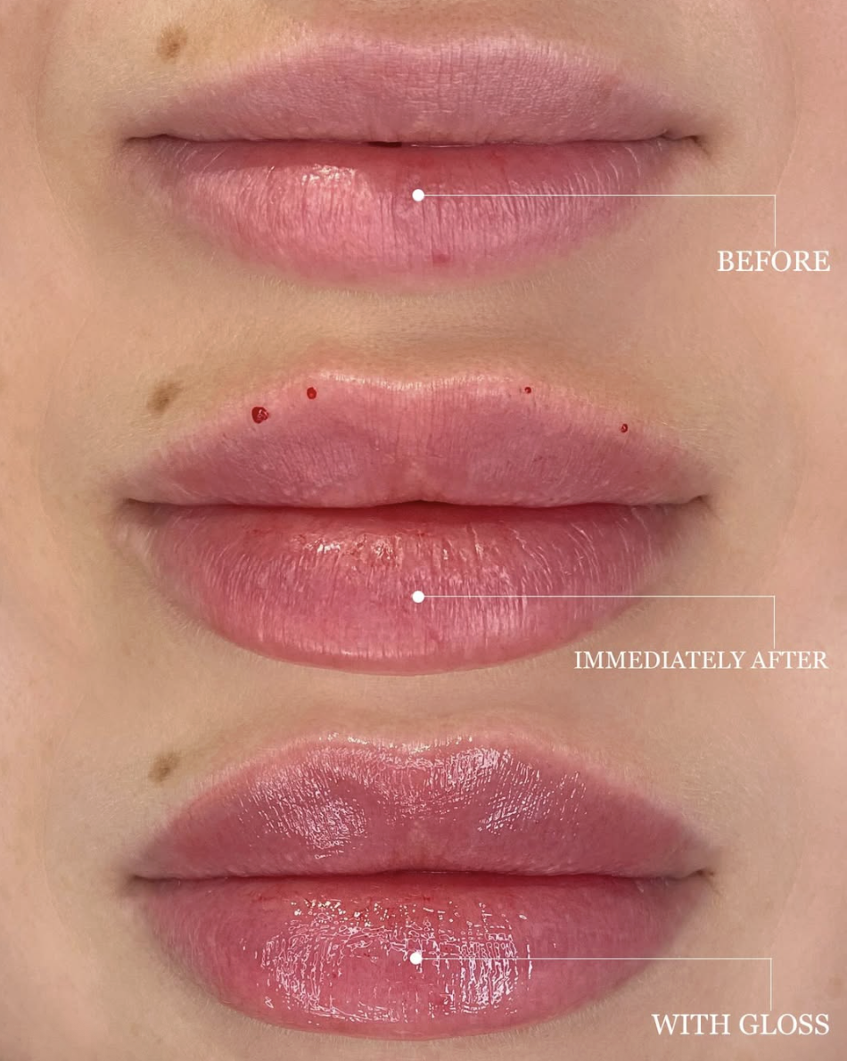 Close-up of lips showing the before, immediate after, and with gloss stages of lip enhancement or application process.