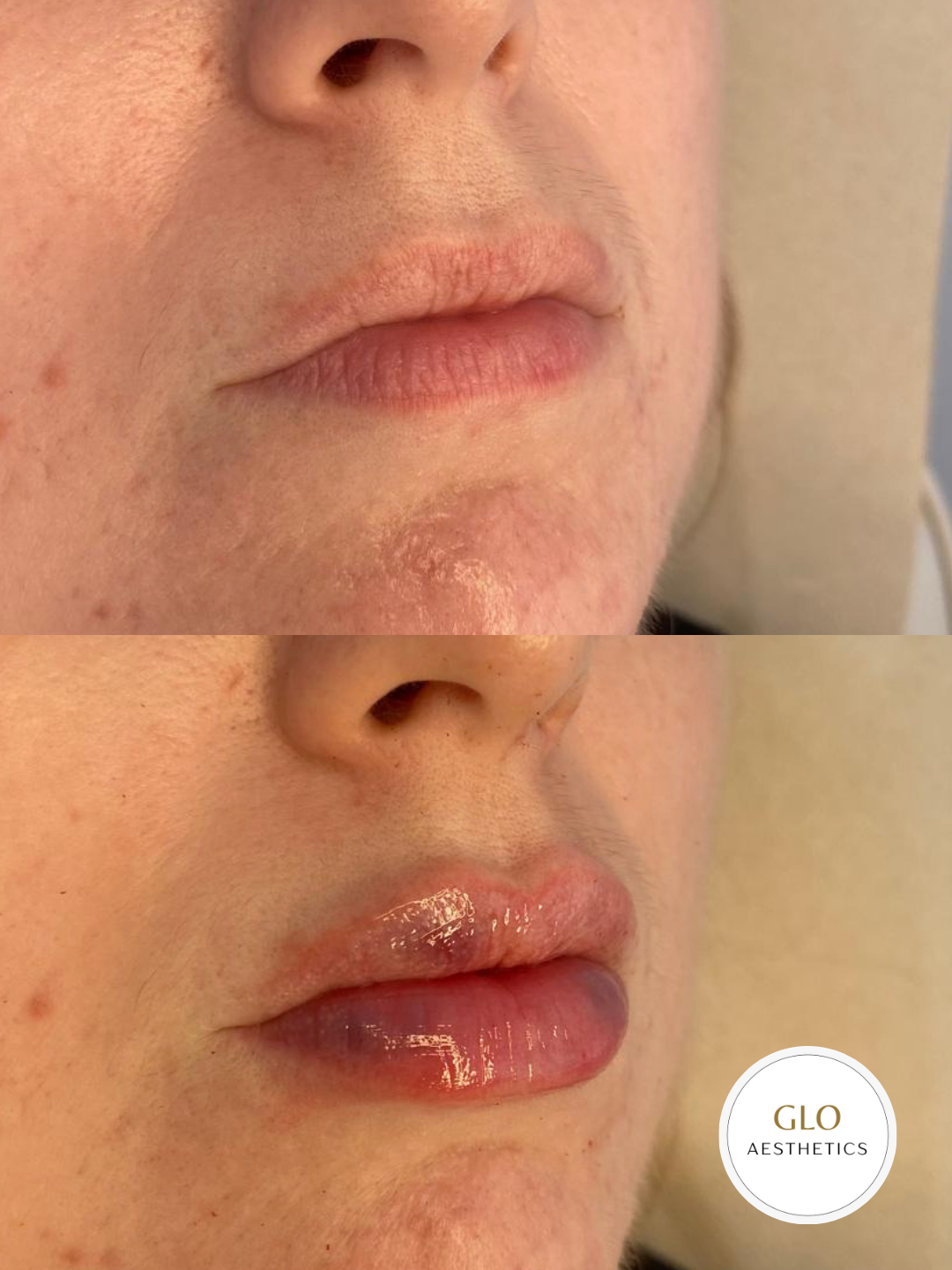 What to Expect After Lip Filler: Swelling, Bruising &amp; The First Few Days