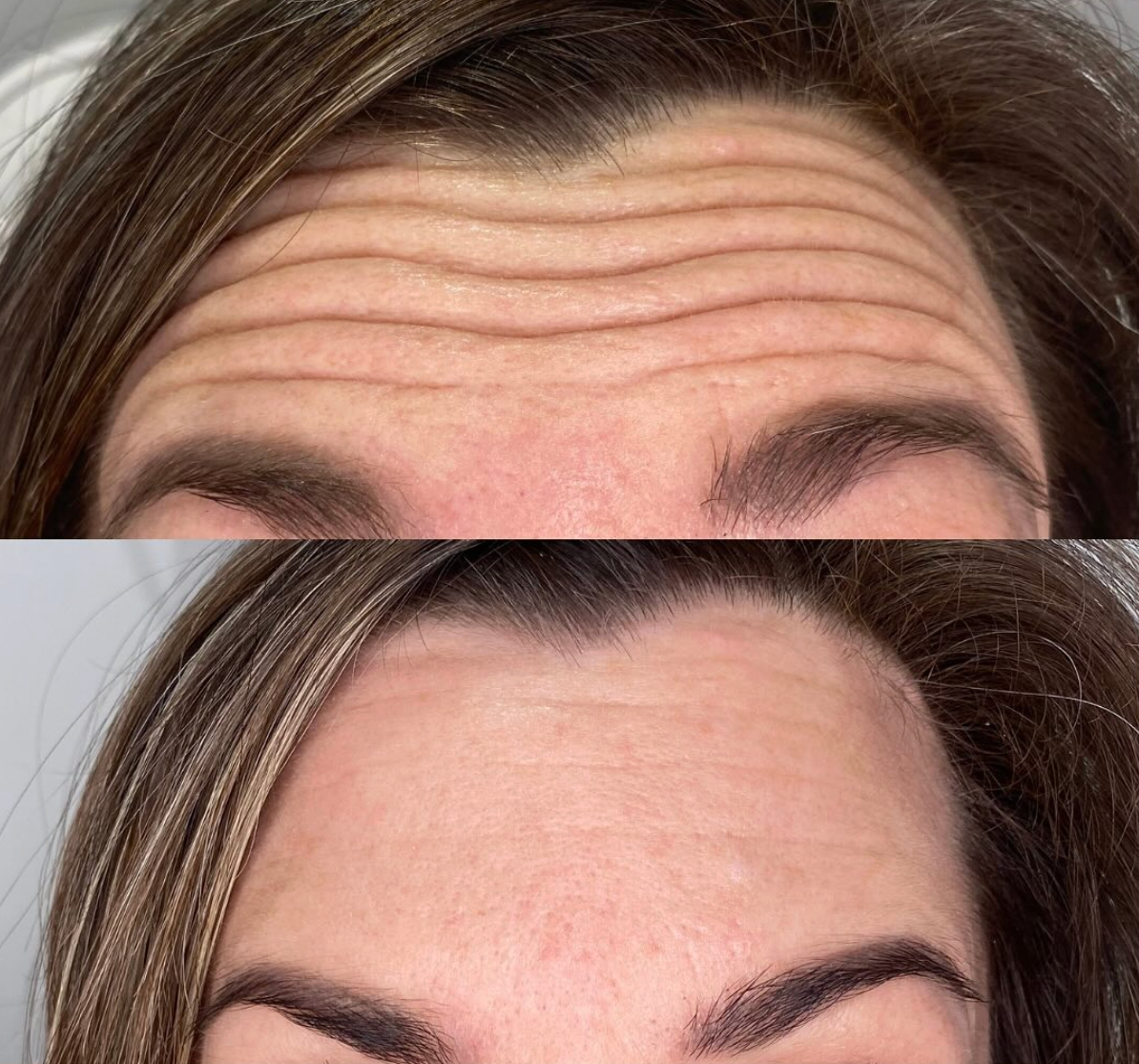 Close-up of a woman's forehead showing before and after comparison of wrinkle reduction, with smoother skin in the lower image.