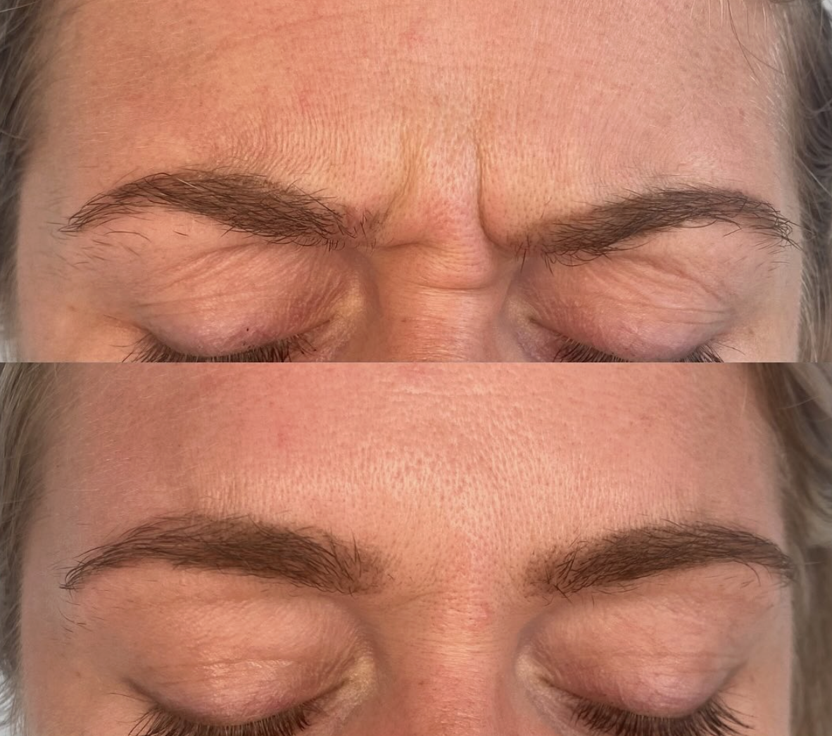 Frown line anti-wrinkle and Botox injections results in Rustington, West Sussex