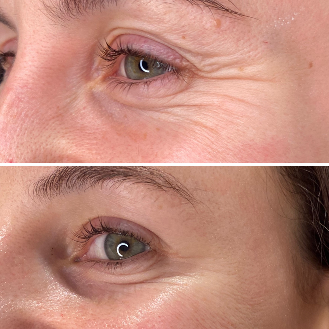 Close-up of a person's face showing a before-and-after comparison of eyelid skin, highlighting reduced wrinkles and smoother appearance in the lower image.