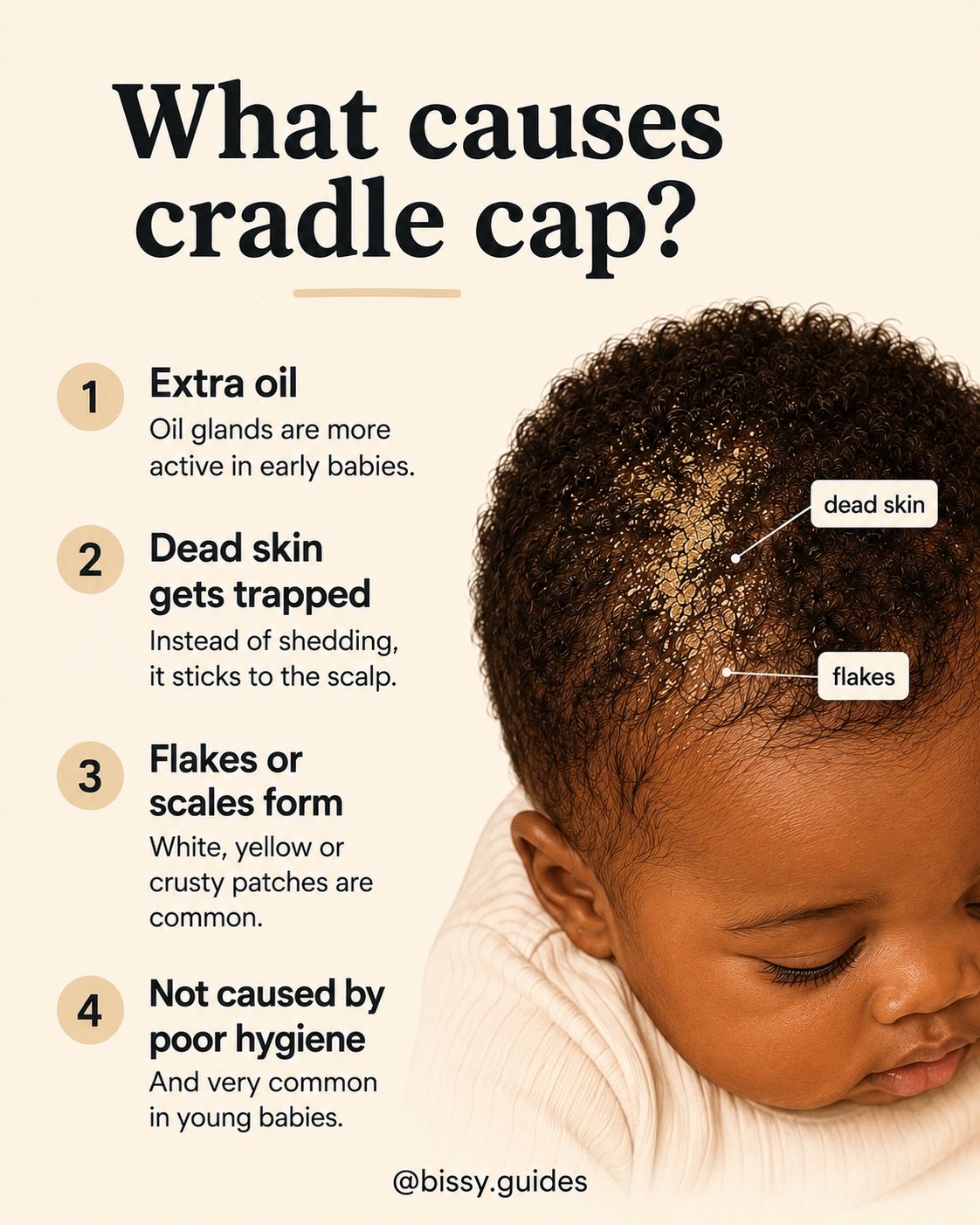 Close-up of baby scalp showing cradle cap flakes with labelled explanation of oil and dead skin build-up.