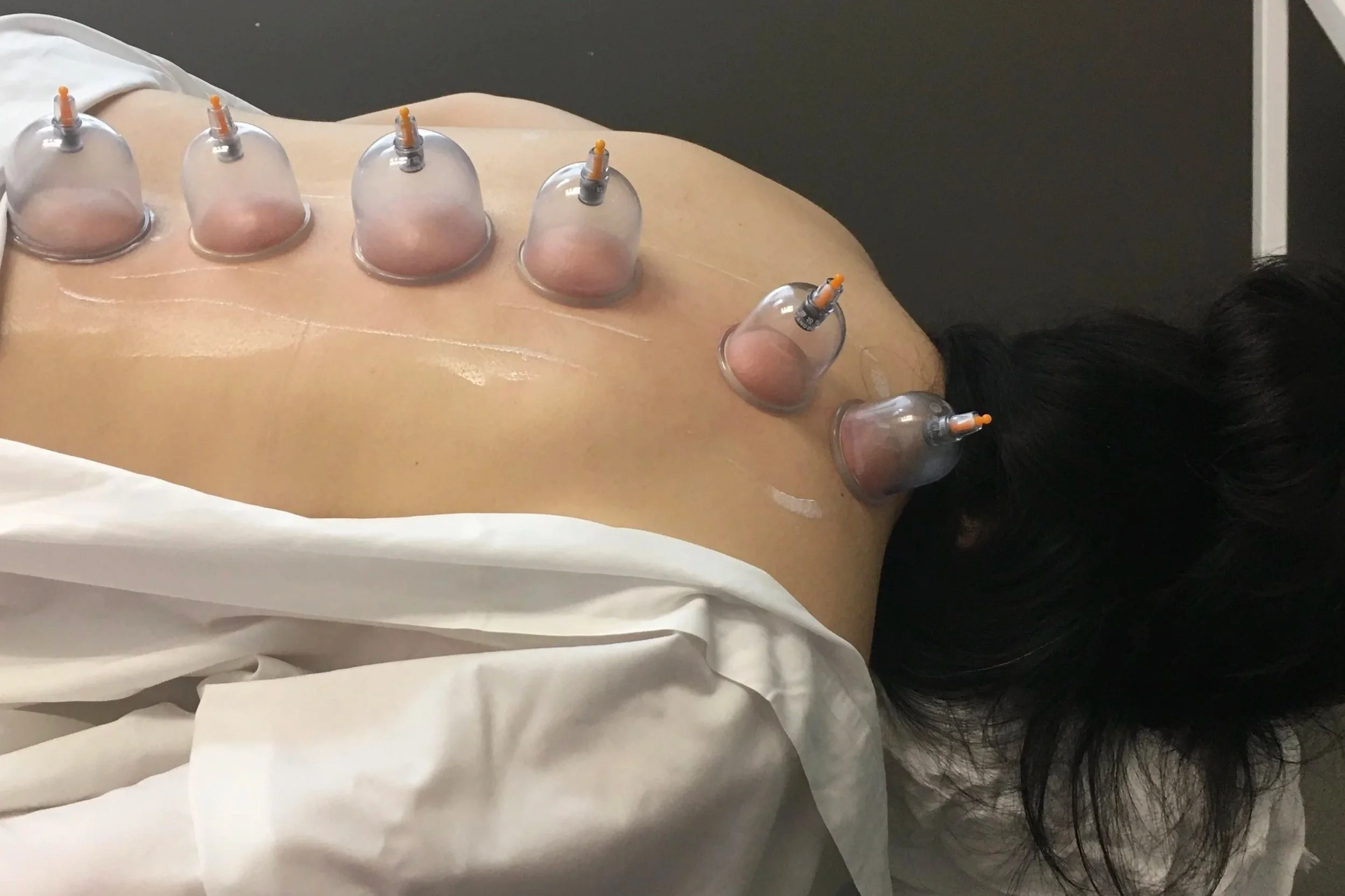 cupping