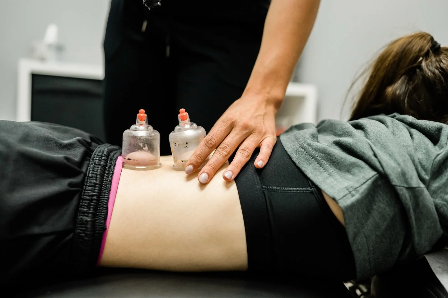 A person receiving an acupuncture treatment with small cups placed on their back.