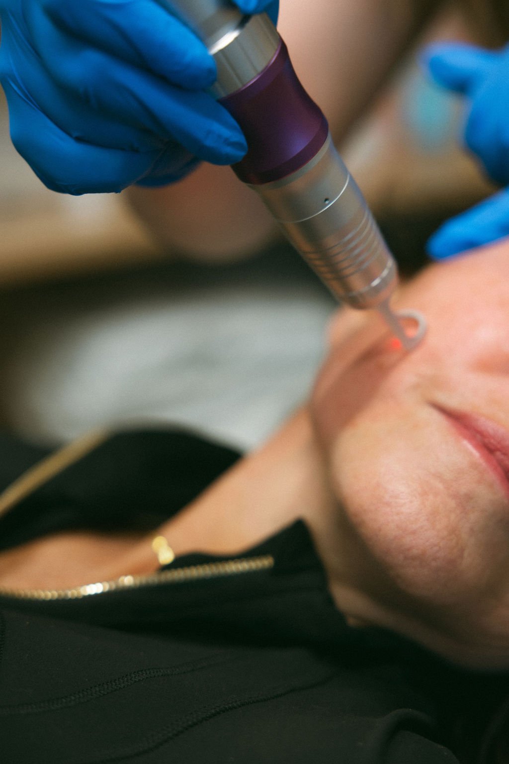 A person receiving a cosmetic or dermatological treatment with a handheld device on their face, wearing a black top and someone in blue gloves operating the device.
