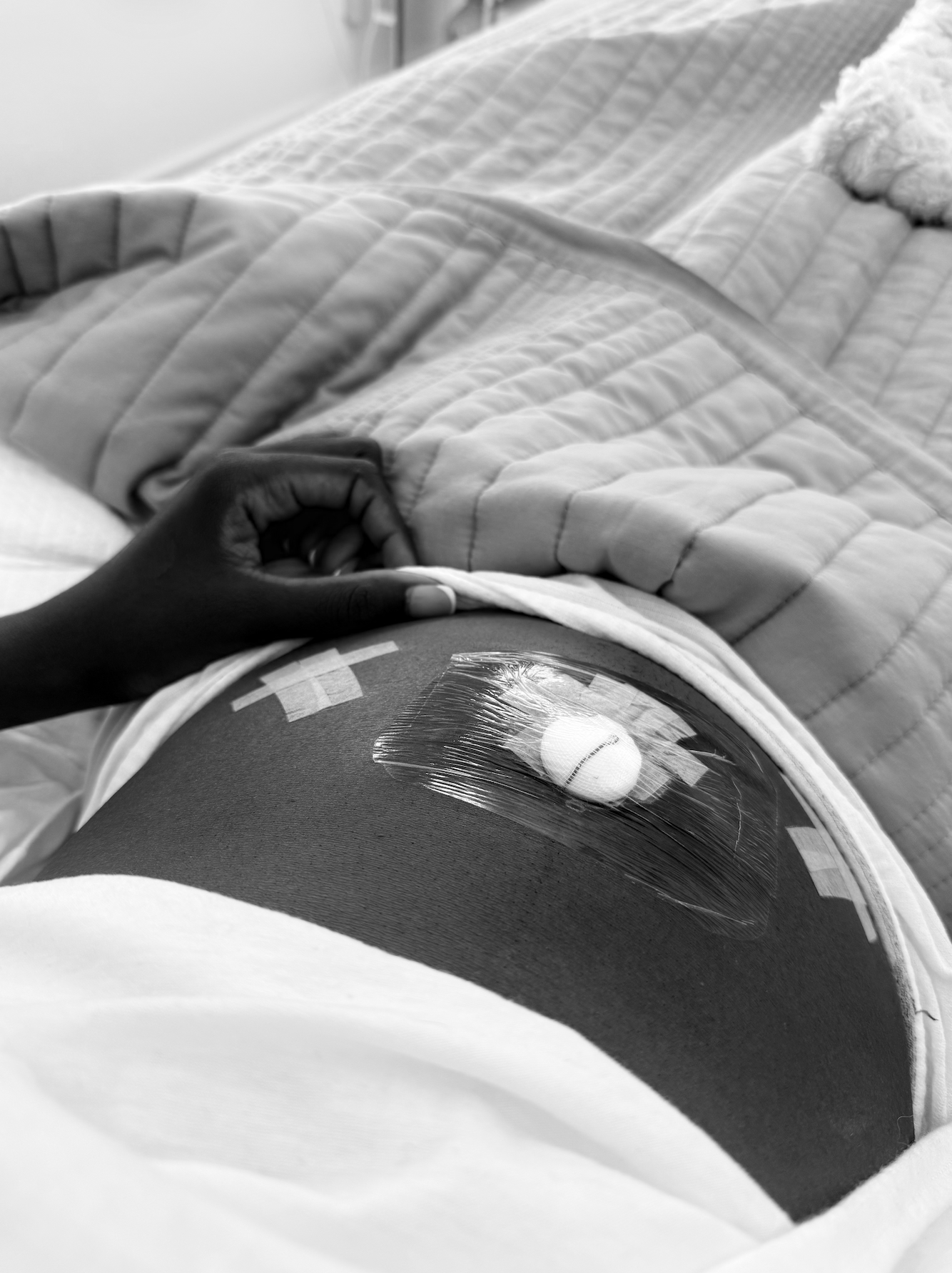 What No One Told Me About My Myomectomy Recovery: Cost, Pain, Recovery Time &amp; Support