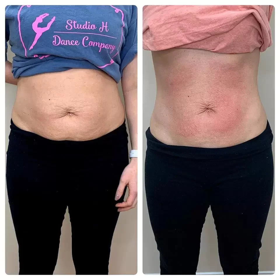Before and after images showing abdominal transformation, with reduced loose skin and skin redness on the right.