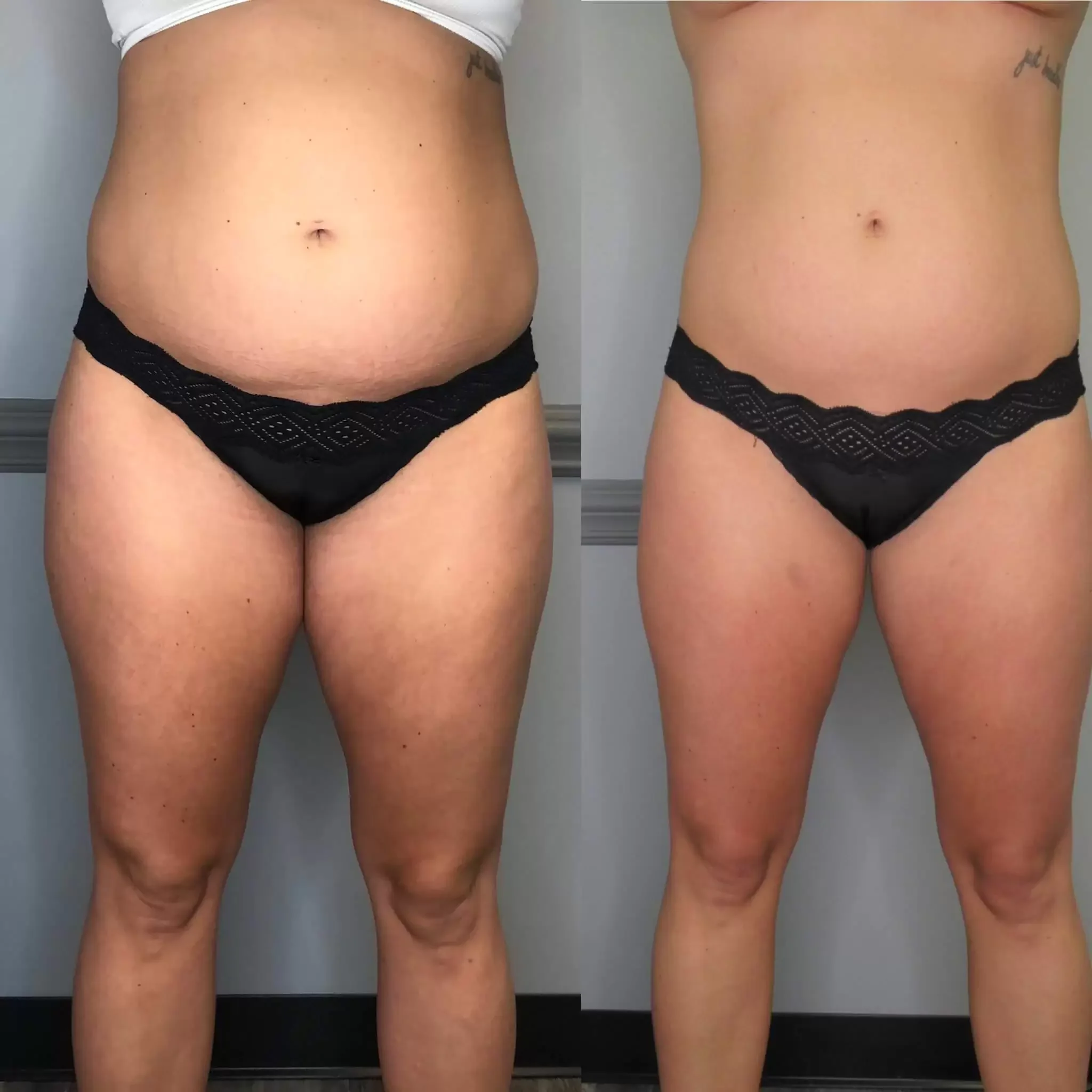 Comparison of a woman's abdomen before and after weight loss, with visible reduction in belly size.