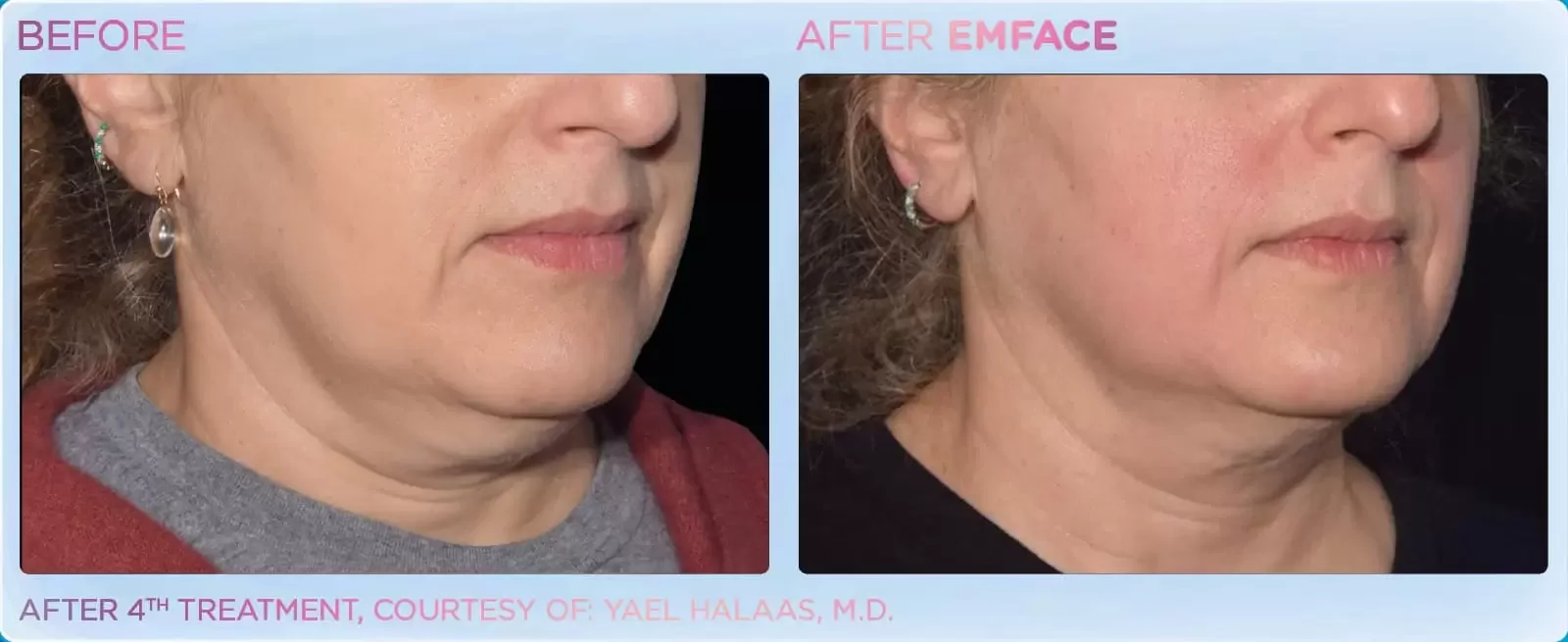 Side-by-side comparison of a woman's face before and after Emface treatment. The 'before' image shows a double chin and less defined jawline, while the 'after' image shows a more contoured jawline with reduced double chin. Text indicates this is after the 4th treatment, provided by Dr. Yael Halaas.