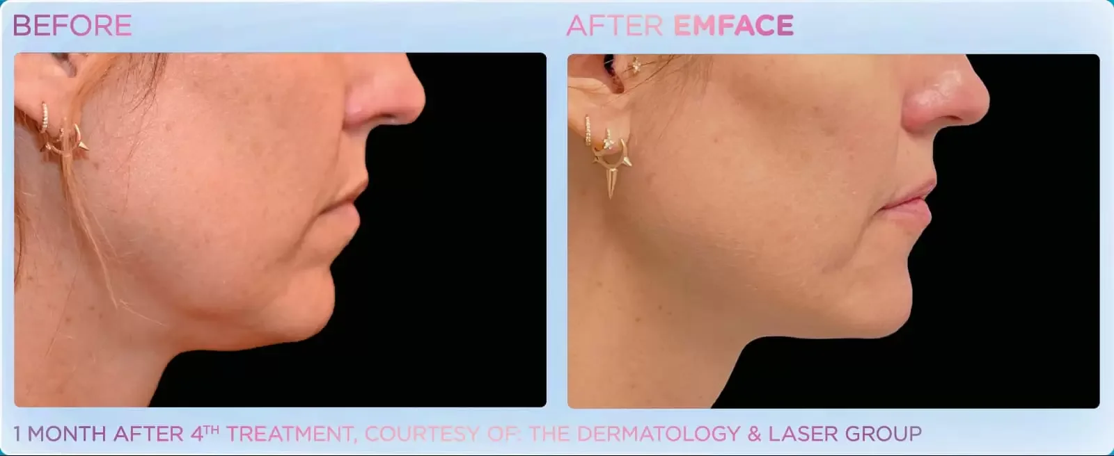 Side-by-side comparison of a woman's face showing before and after skincare treatment. The 'before' image shows the side of the face with uneven skin tone and texture. The 'after' image shows smoother, clearer skin. Text indicates the photos are taken one month after a fourth treatment, courtesy of a dermatology and laser group.
