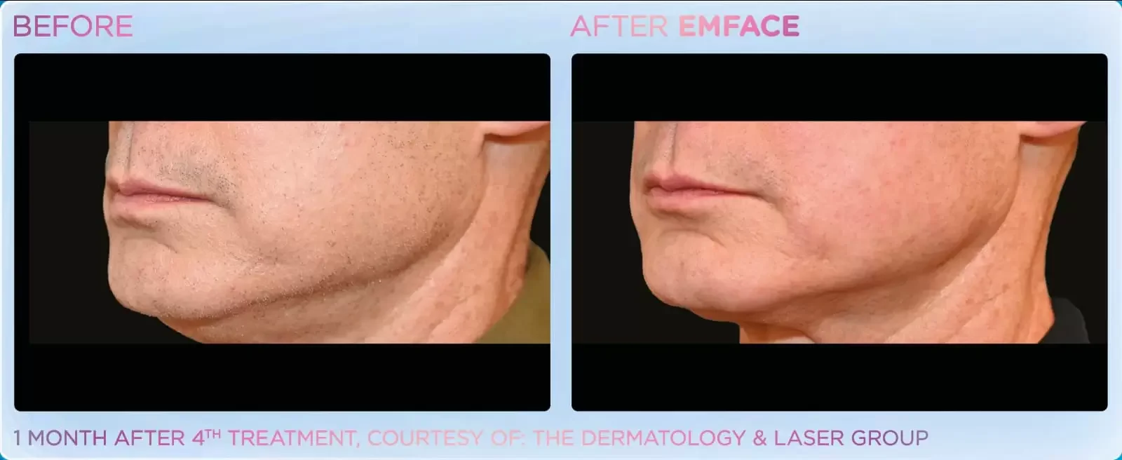 A side-by-side comparison of a person's chin and jawline before and after a skin treatment. The 'before' image shows a rough, uneven skin texture with signs of aging, while the 'after' image shows smoother, clearer skin with a more youthful appearance.