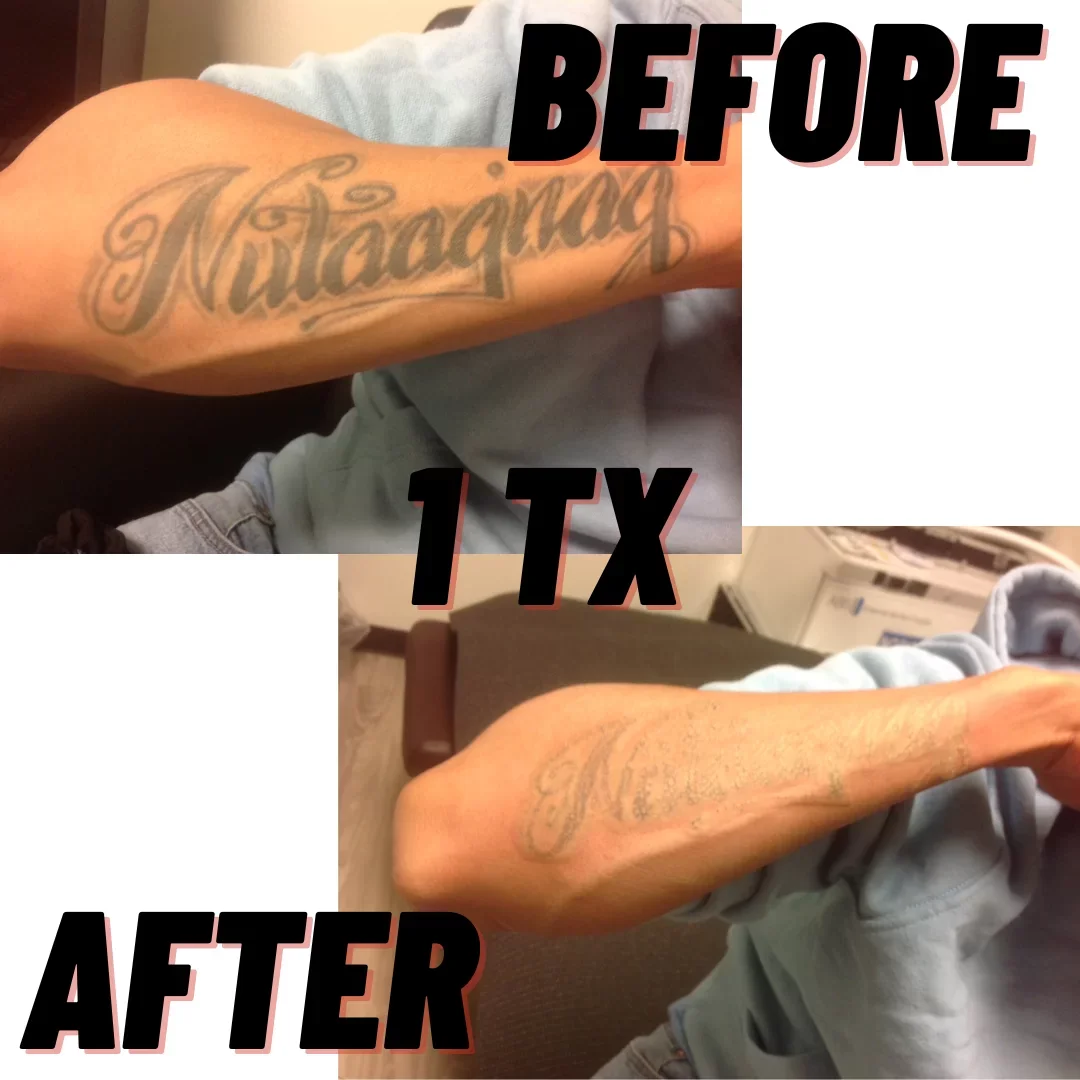 Photo showing a person's arm with a tattoo reading 'Nutága', with the words 'BEFORE 1 TX' and 'AFTER' indicating a tattoo removal process.