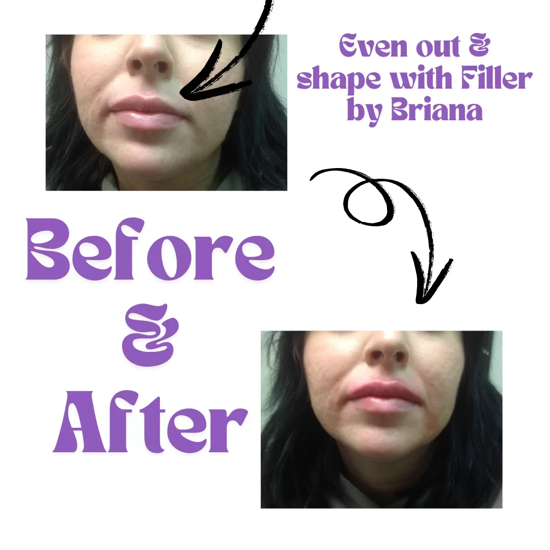 Side-by-side before and after photos of a woman showing the results of filler treatment on her upper lip area, with text indicating changes and the name Briana.