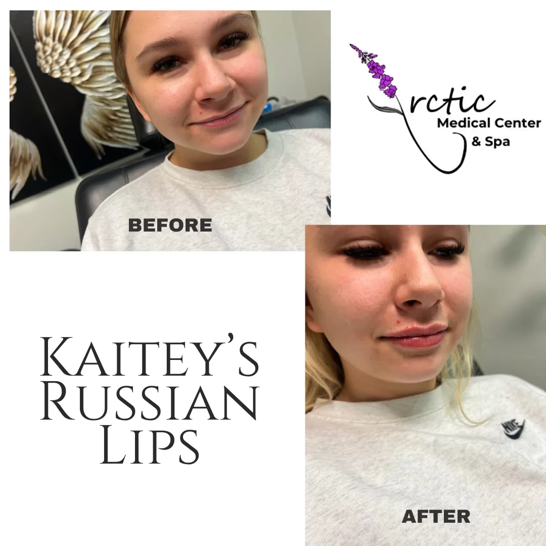 Side-by-side comparison of a woman's face before and after lip enhancement, with the before photo showing natural lips and the after photo showing fuller, more defined lips; the photo includes the Arctic Medical Center & Spa logo and the text "KAITY'S RUSSIAN LIPS".